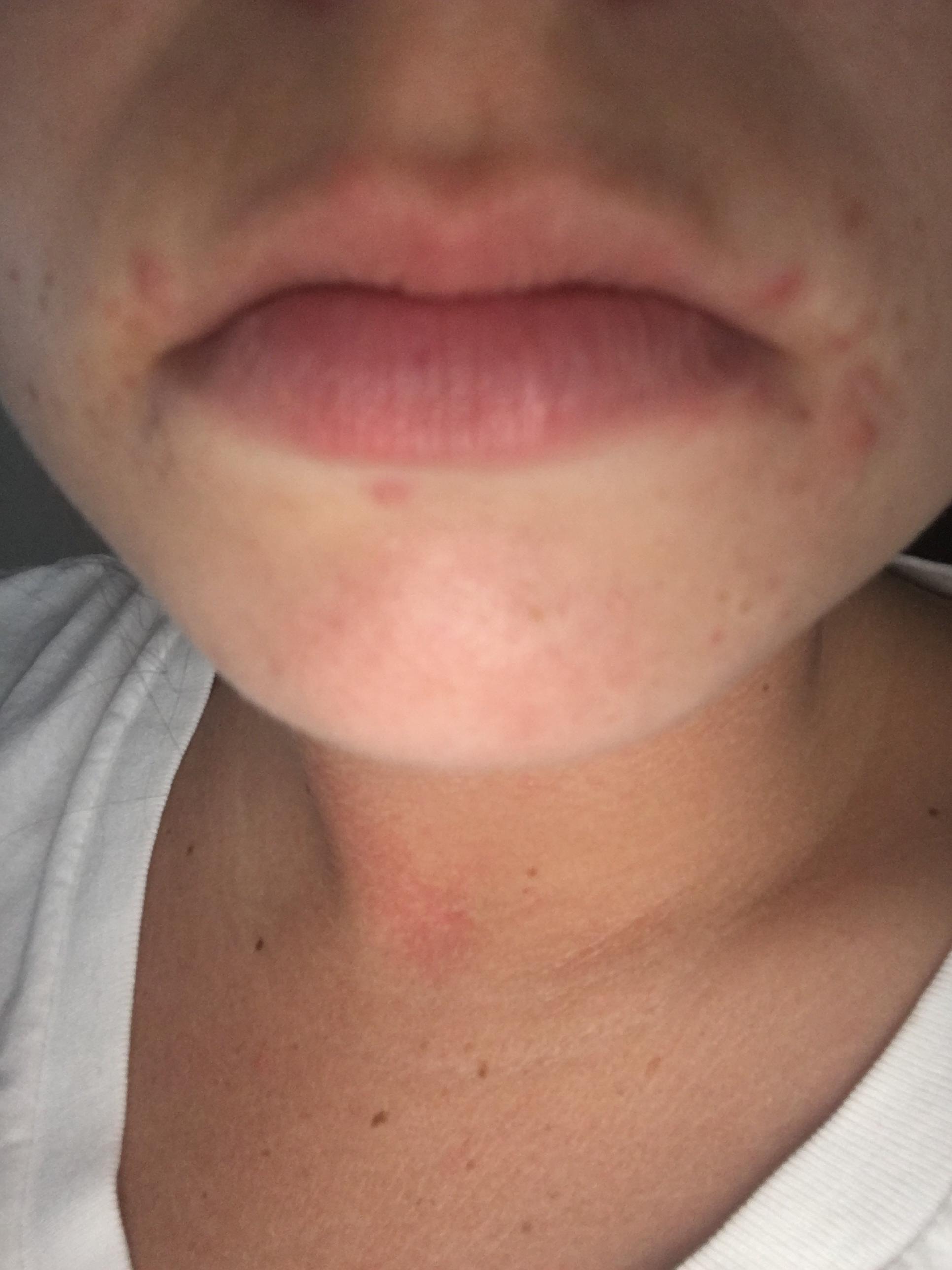 [Acne] does anyone know what to do about acne like this? It's only