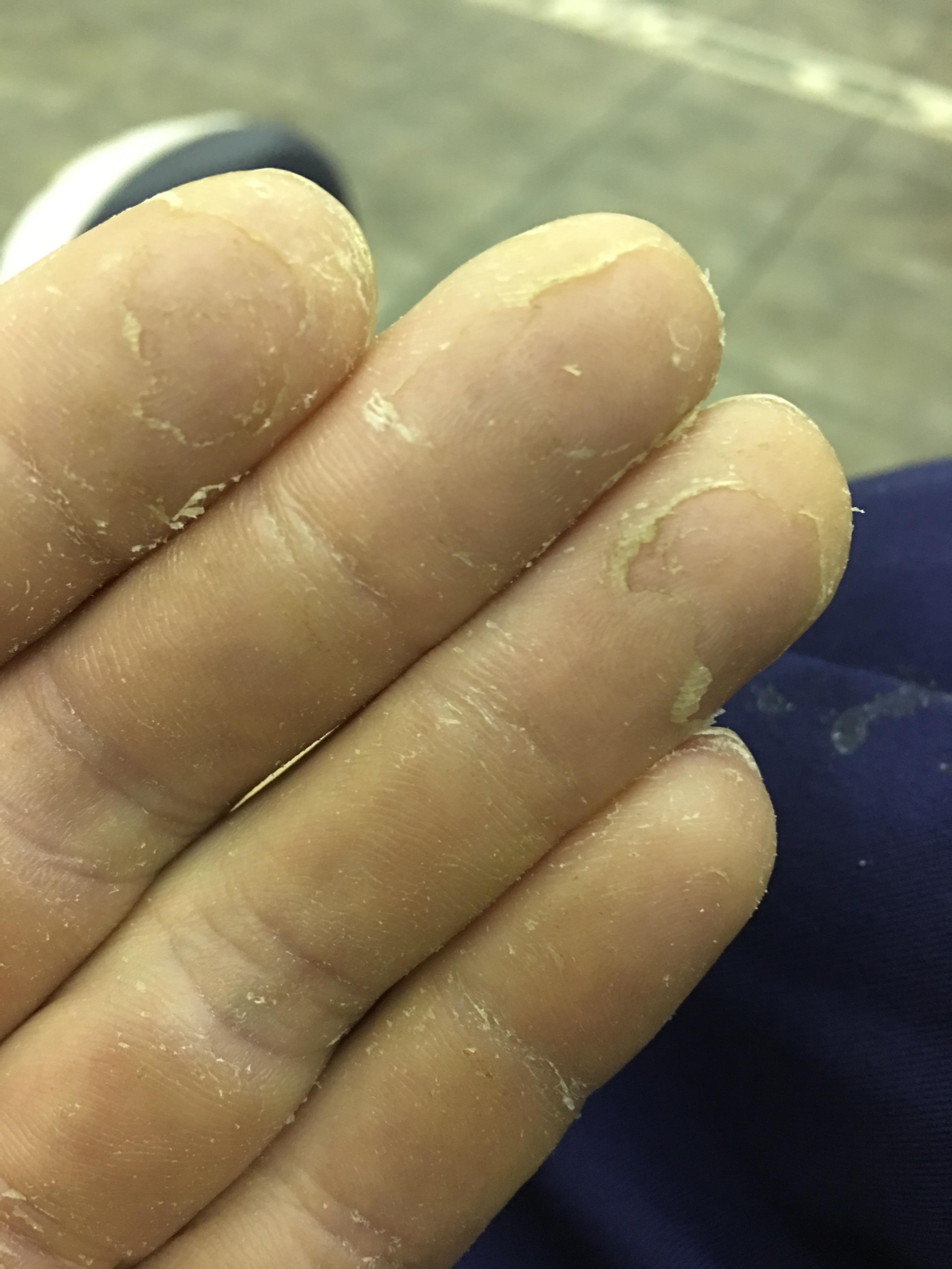 How do I fix this ? Is it just extra skin or something ? r/climbharder