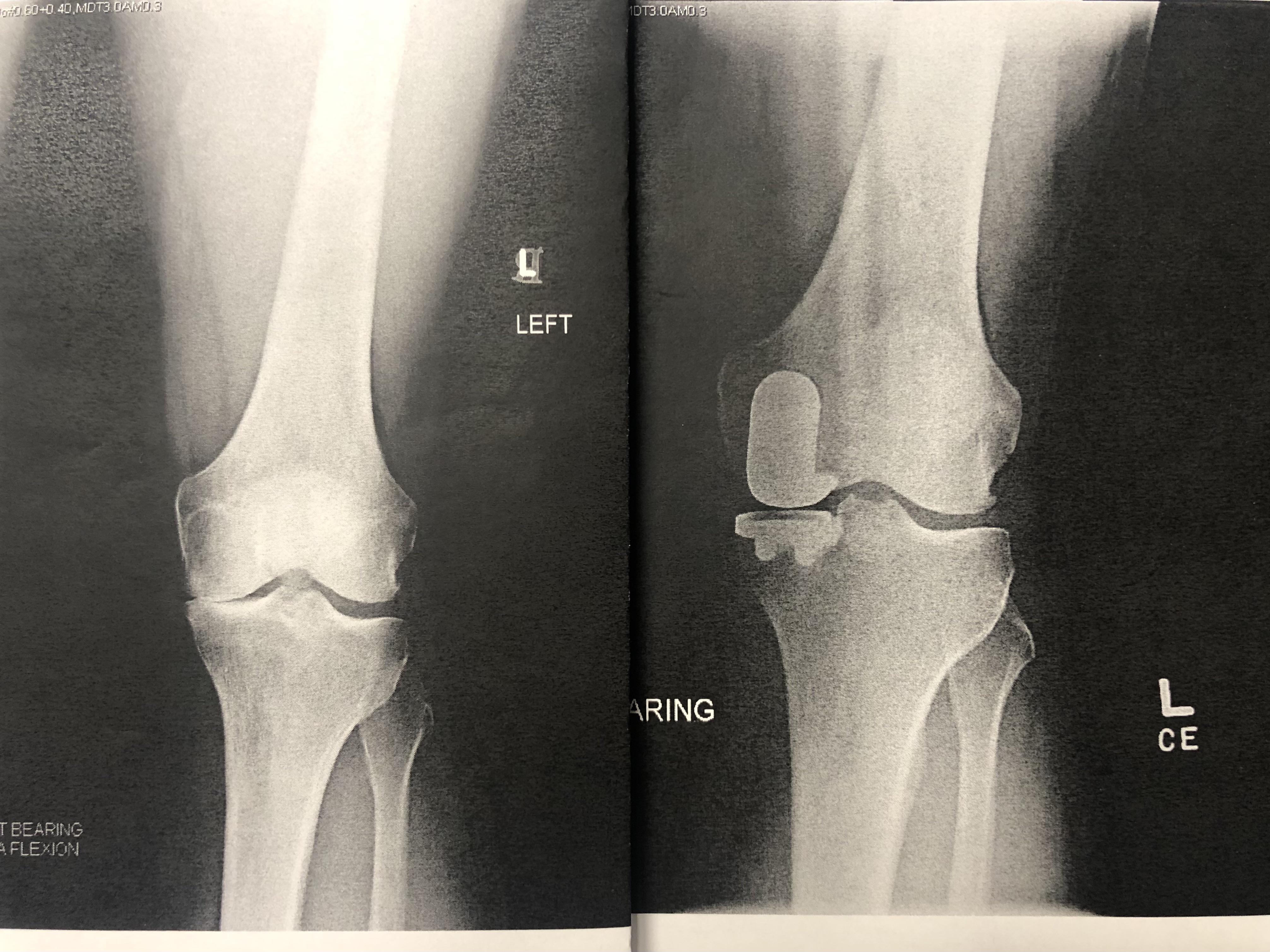 Before/After my partial knee replacement surgery. You can see the bone
