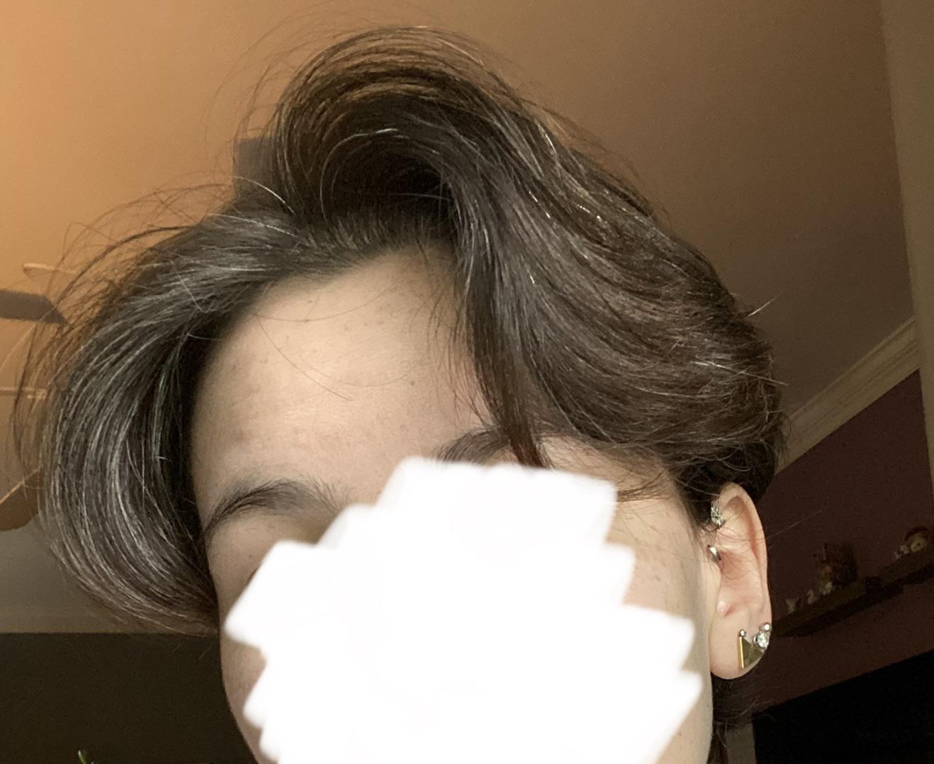 Anyone else find topical minoxidil foam voluminizes your hair for a few