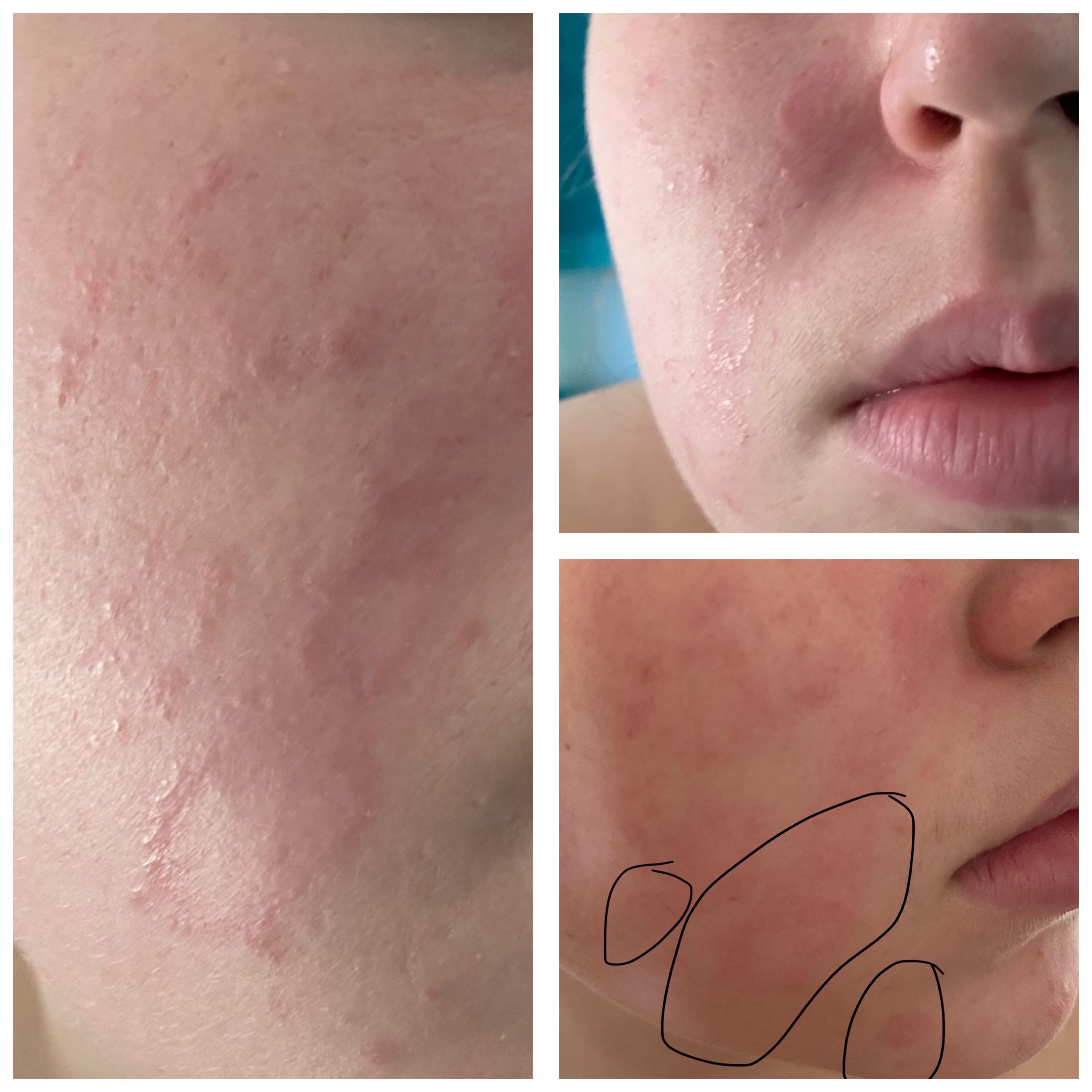 Could anyone help me identify these raised circles on my skin? r