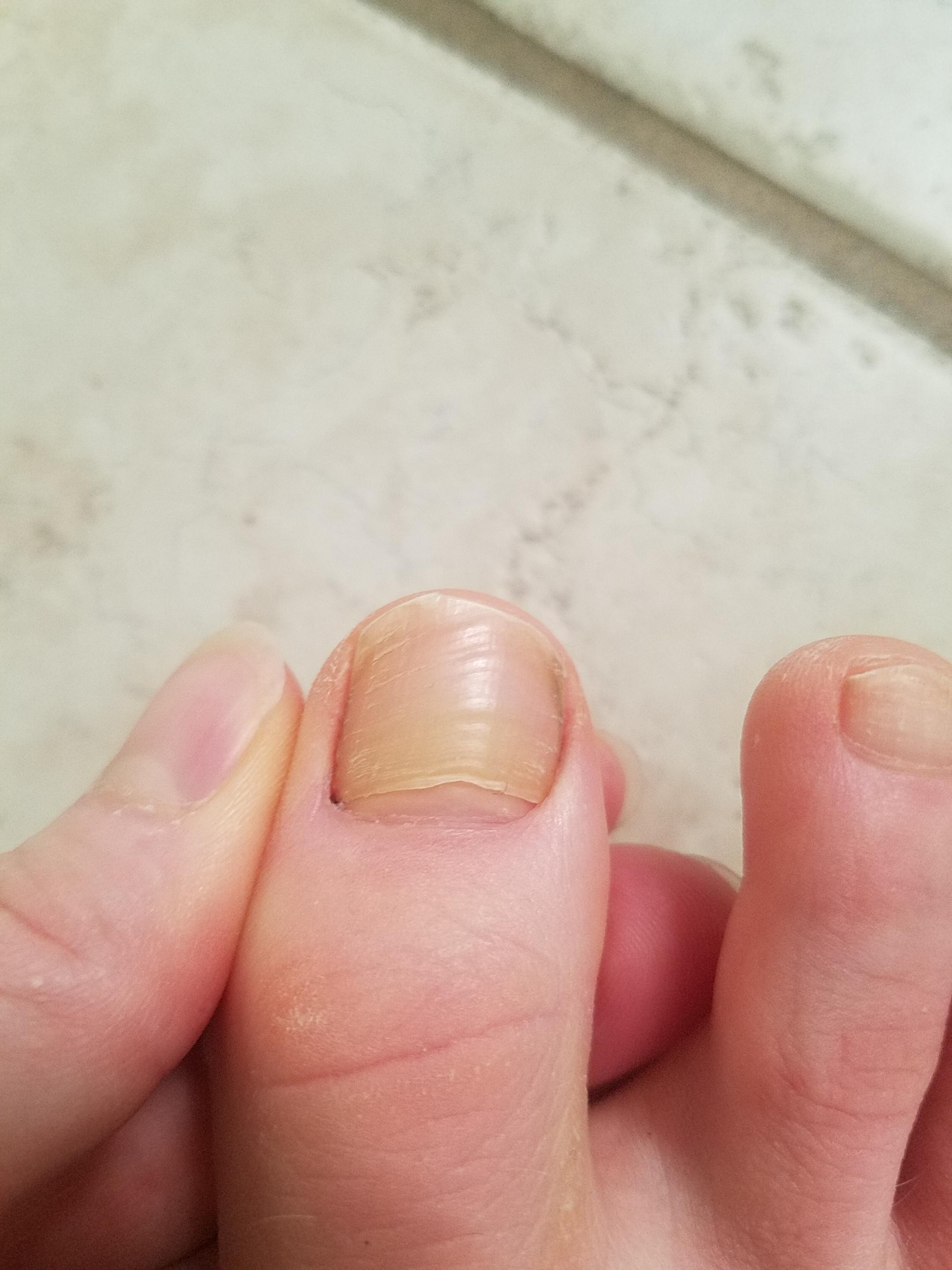 Onycholysis Toenail