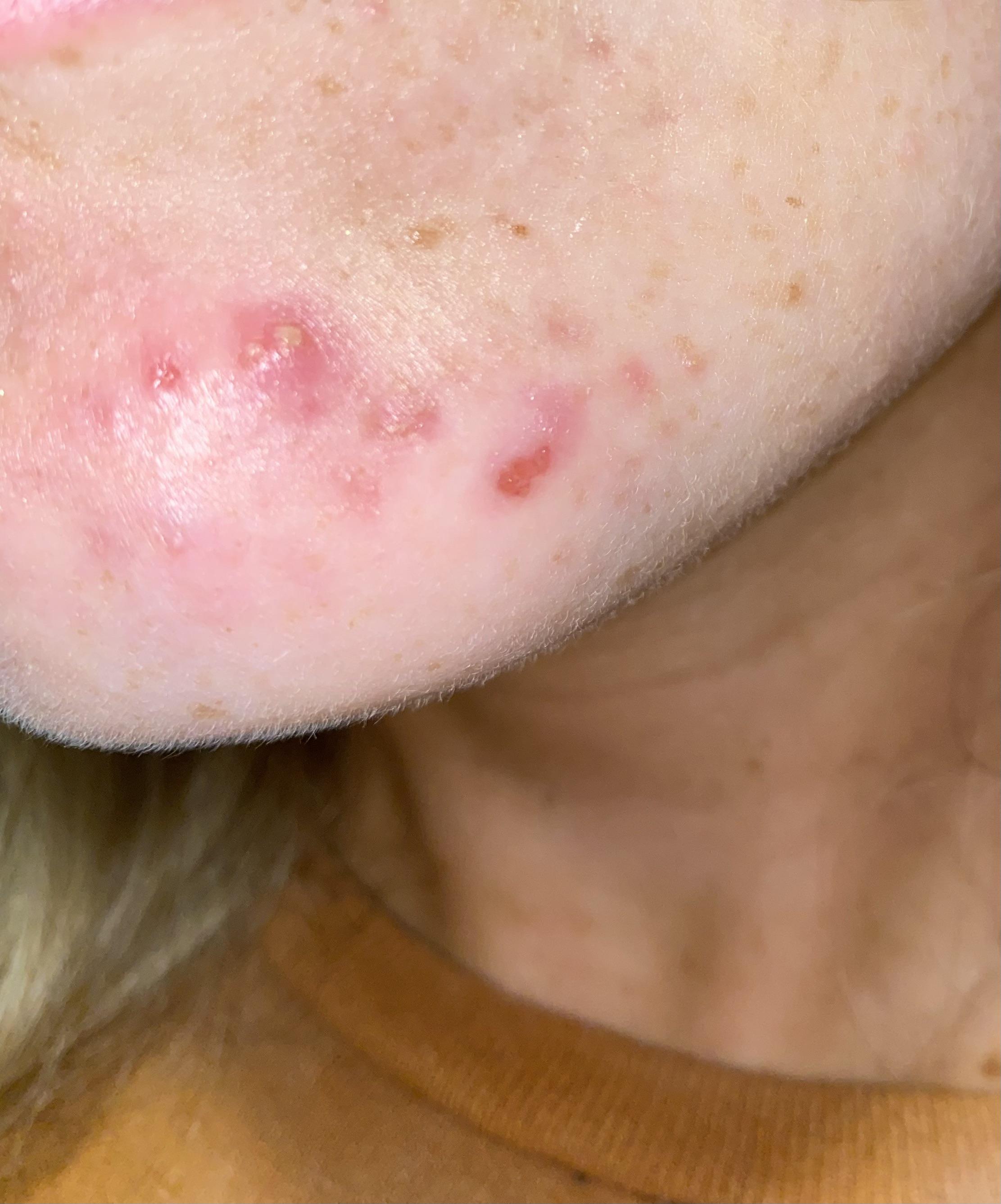 painful cluster of pimples that won’t go away [acne] r/Skincare_Addiction
