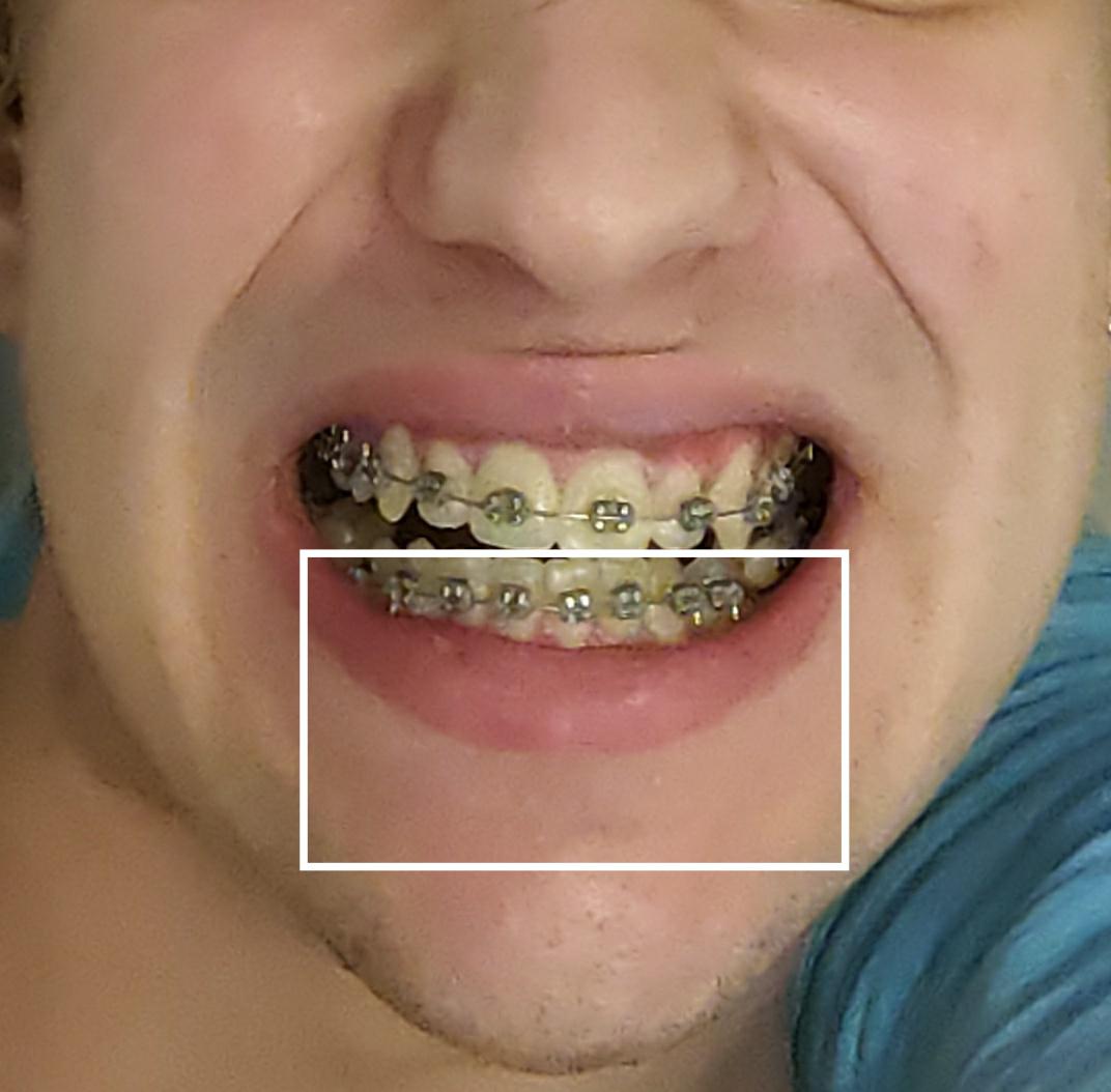 can braces fix my canted smile? r/braces
