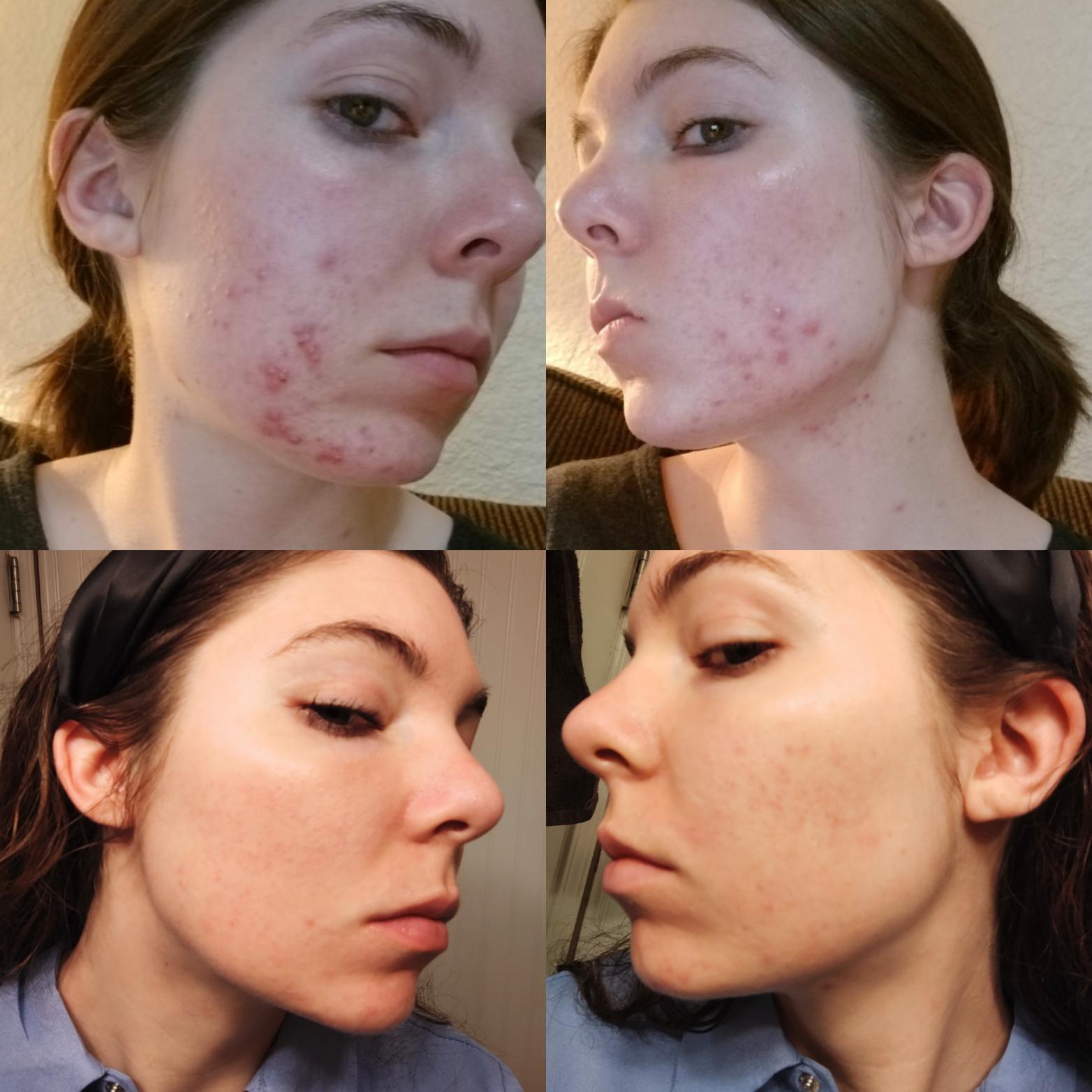 Skincare Routine With Tretinoin Beauty & Health