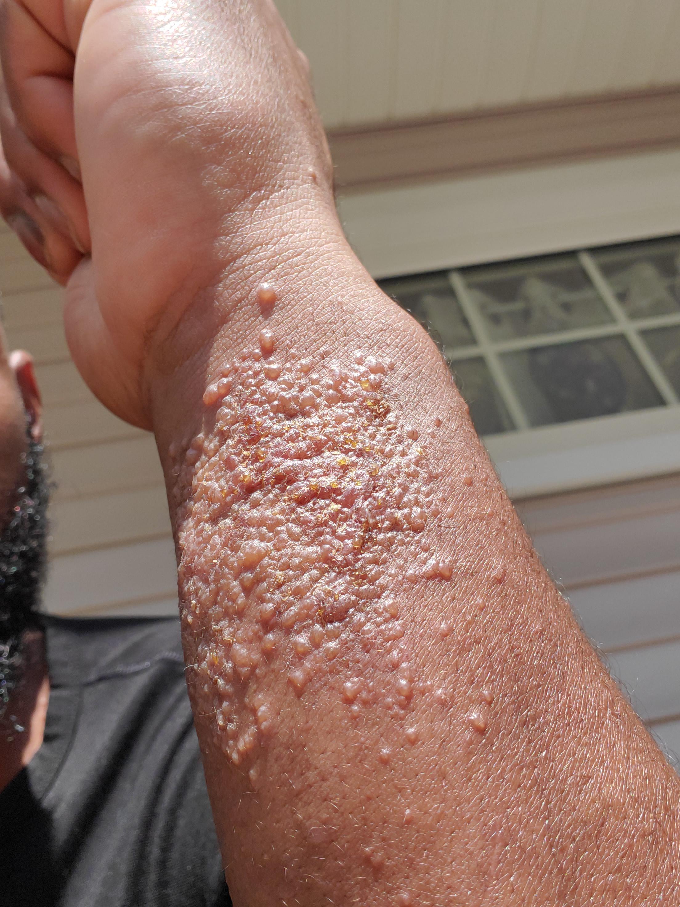 Severe Poison Ivy On Face