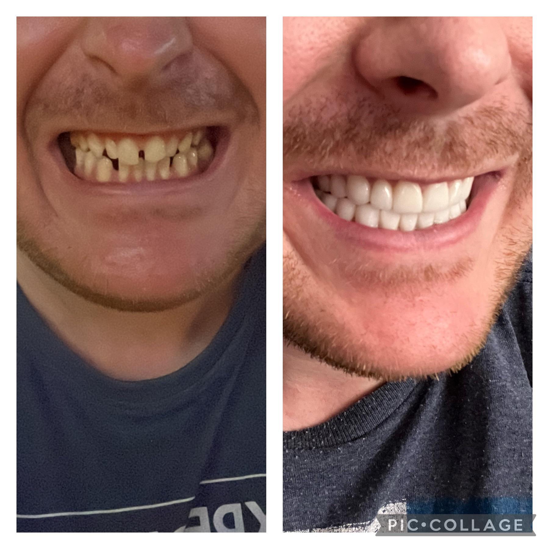 M/31/5’9” [200lbs 200lbs = 0lbs] Smile Progress. Always had crappy