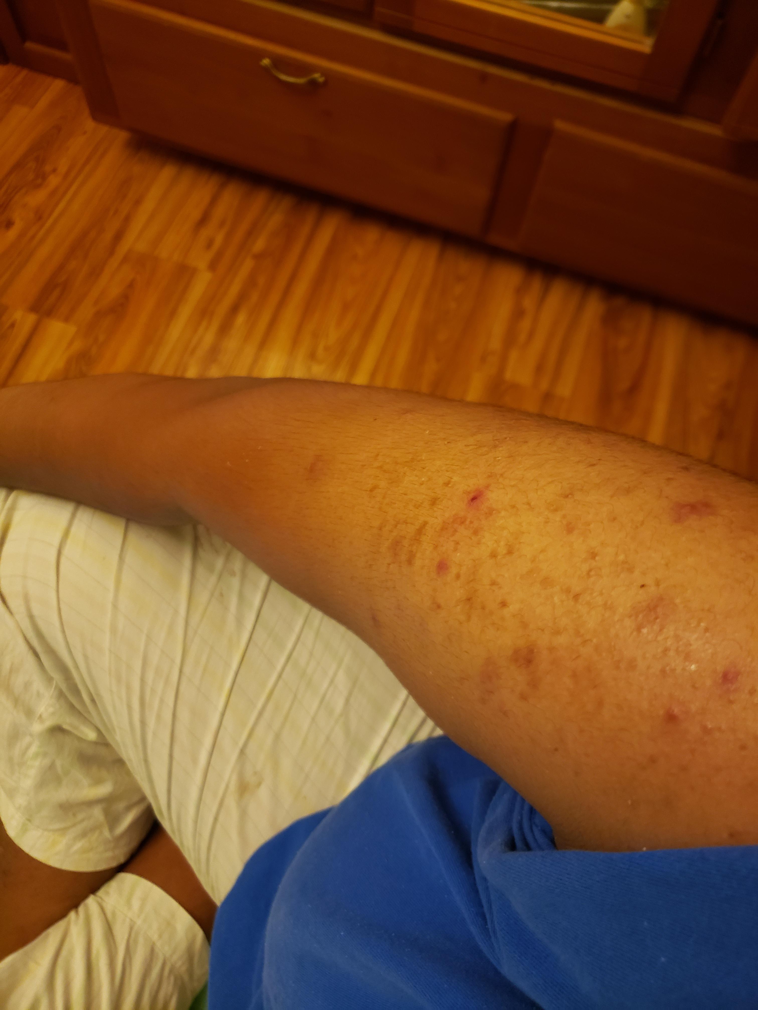 [Routine Help] bad arm acne. Can you guys solutions please!! r/SkincareAddiction