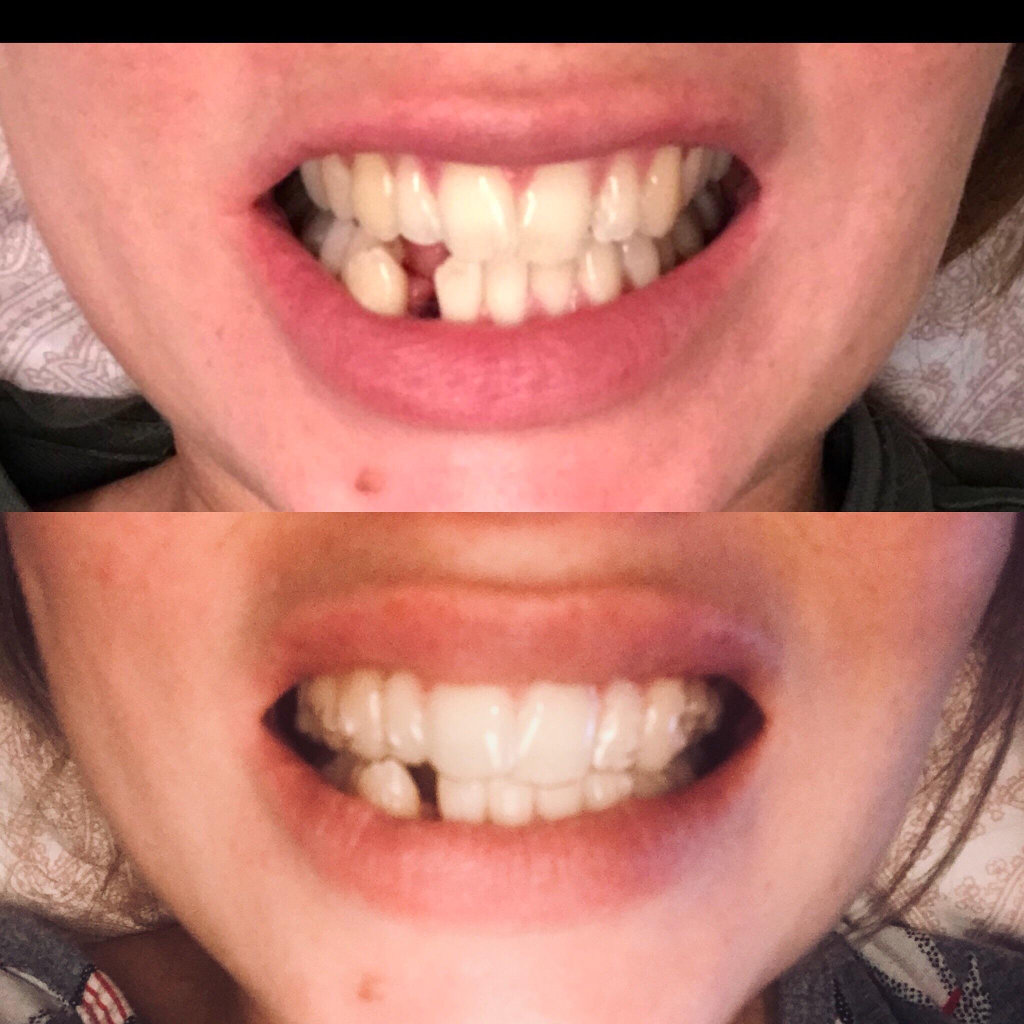 How long will it take to close this gap with invisalign?