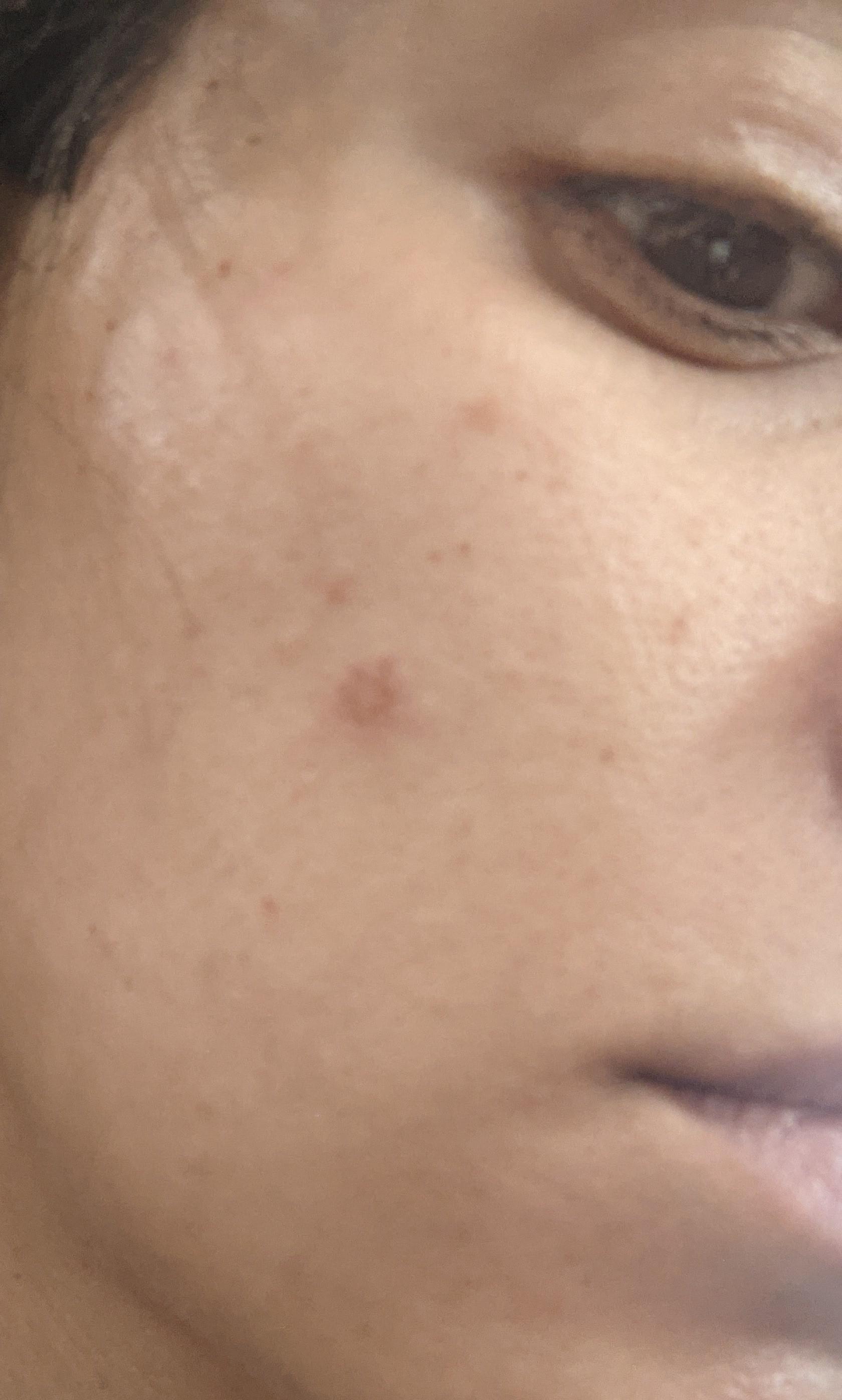 Got a facial etch burn (phosphoric acid) today at the dentist. What can