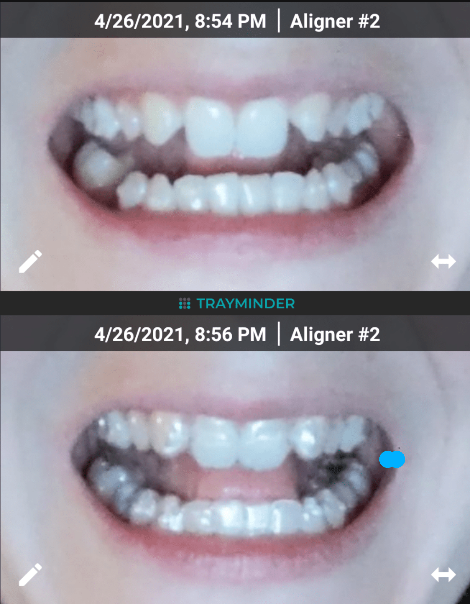 On Tray 2. Missing lateral incisors, retained baby teeth. r/Invisalign