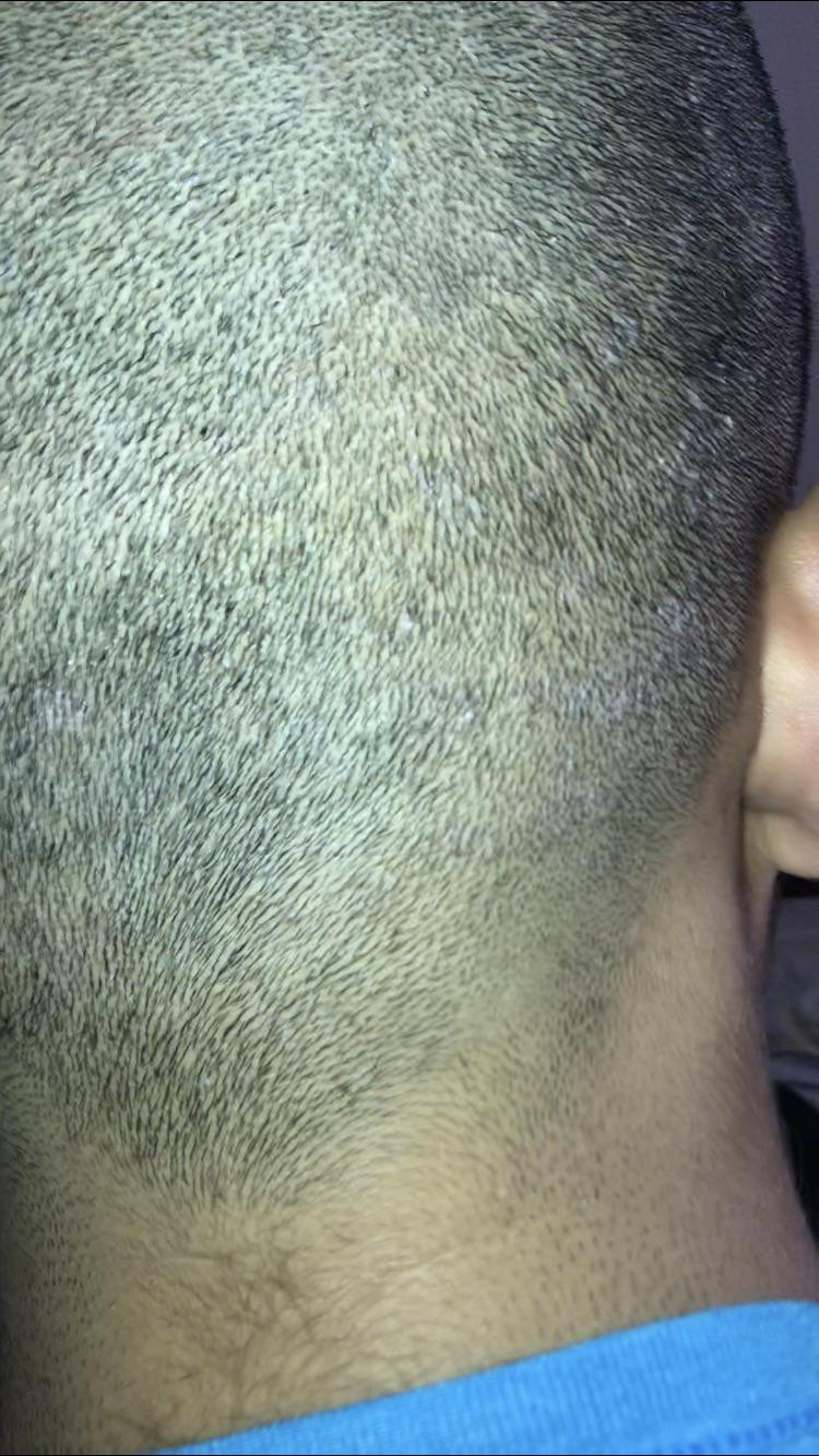 White areas on scalp? r/DermatologyQuestions