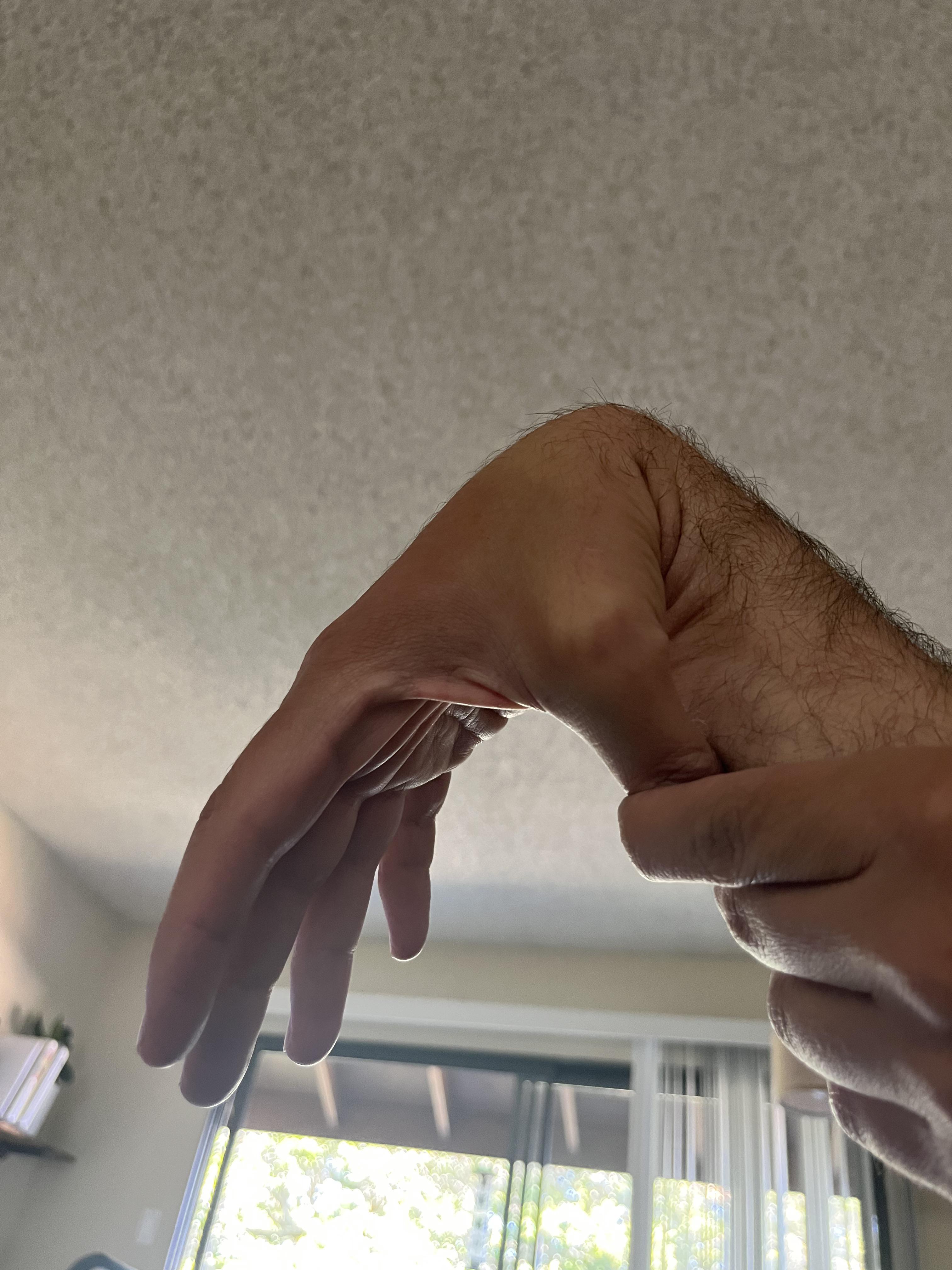 Can you have a hyper mobile wrist/thumb and not have EDS? Or does a