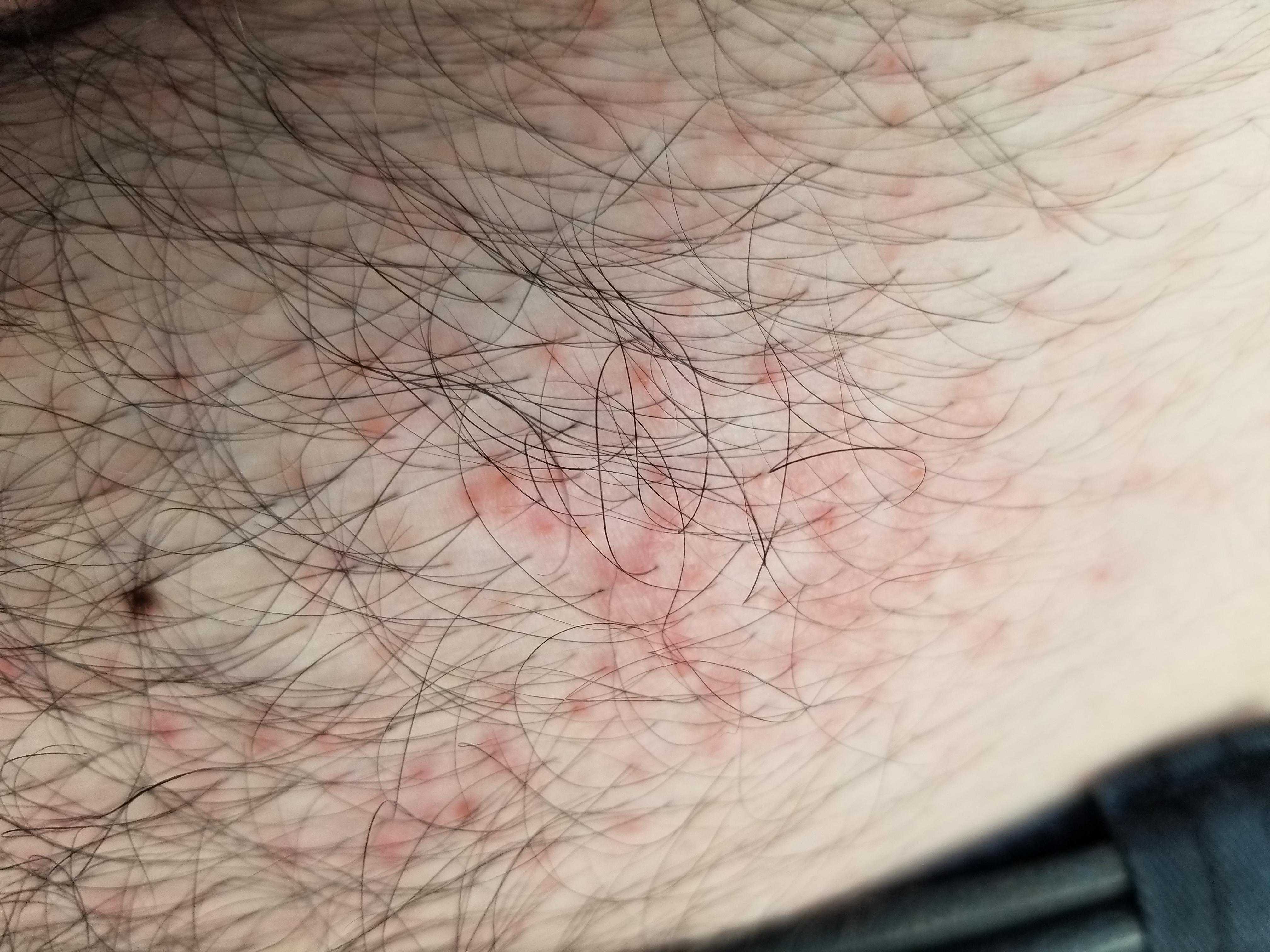 Itchy rash on stomach, slowly worsening. Any ideas what it is? r