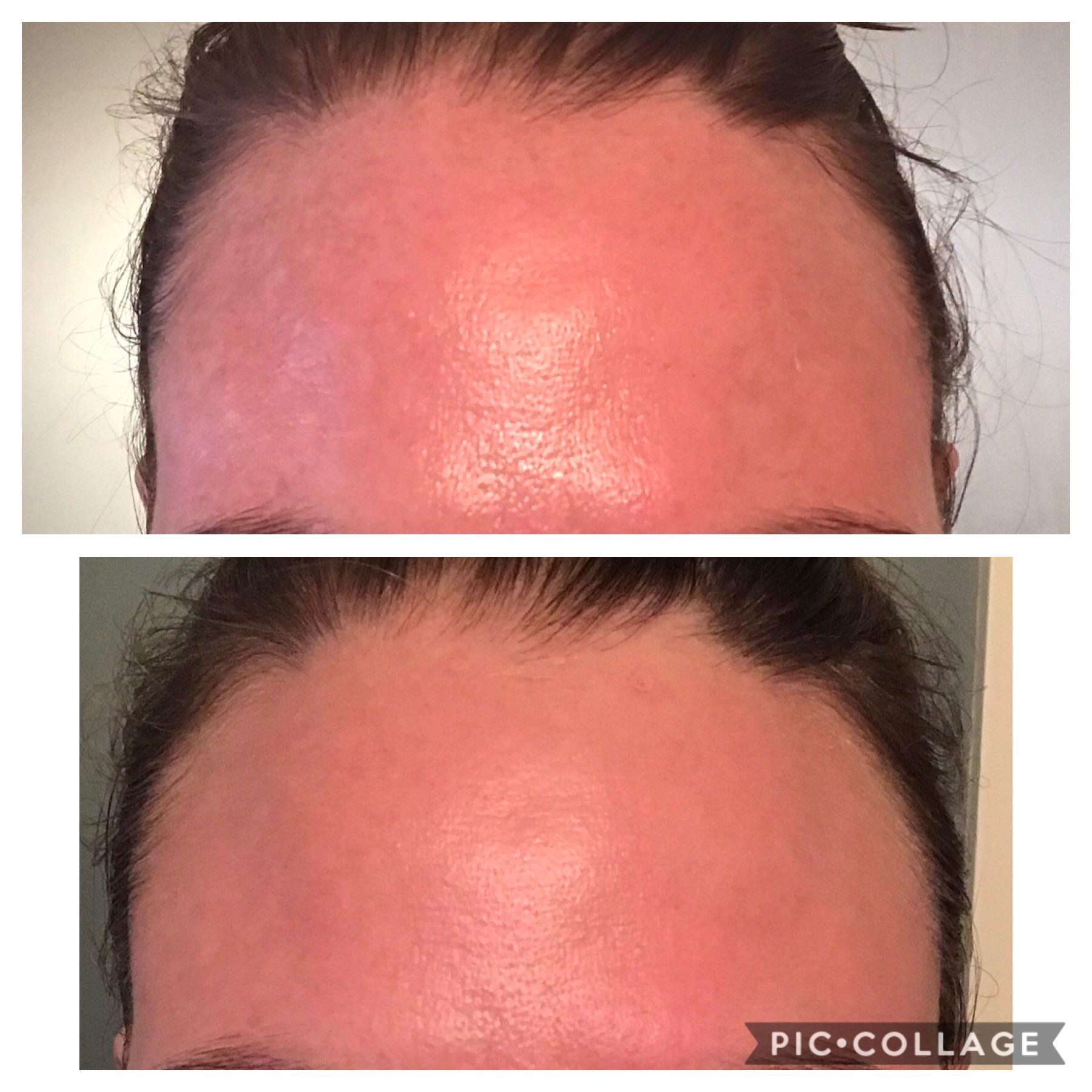 For those using hydroquinone great results here r/Melasmaskincare