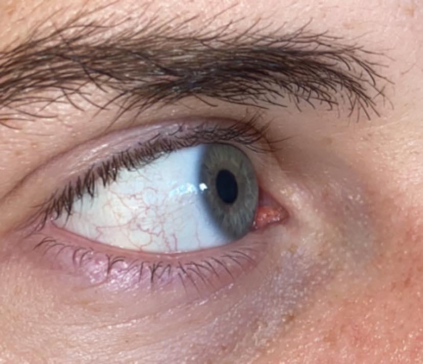 Horrible veins from dry eye r/Dryeyes