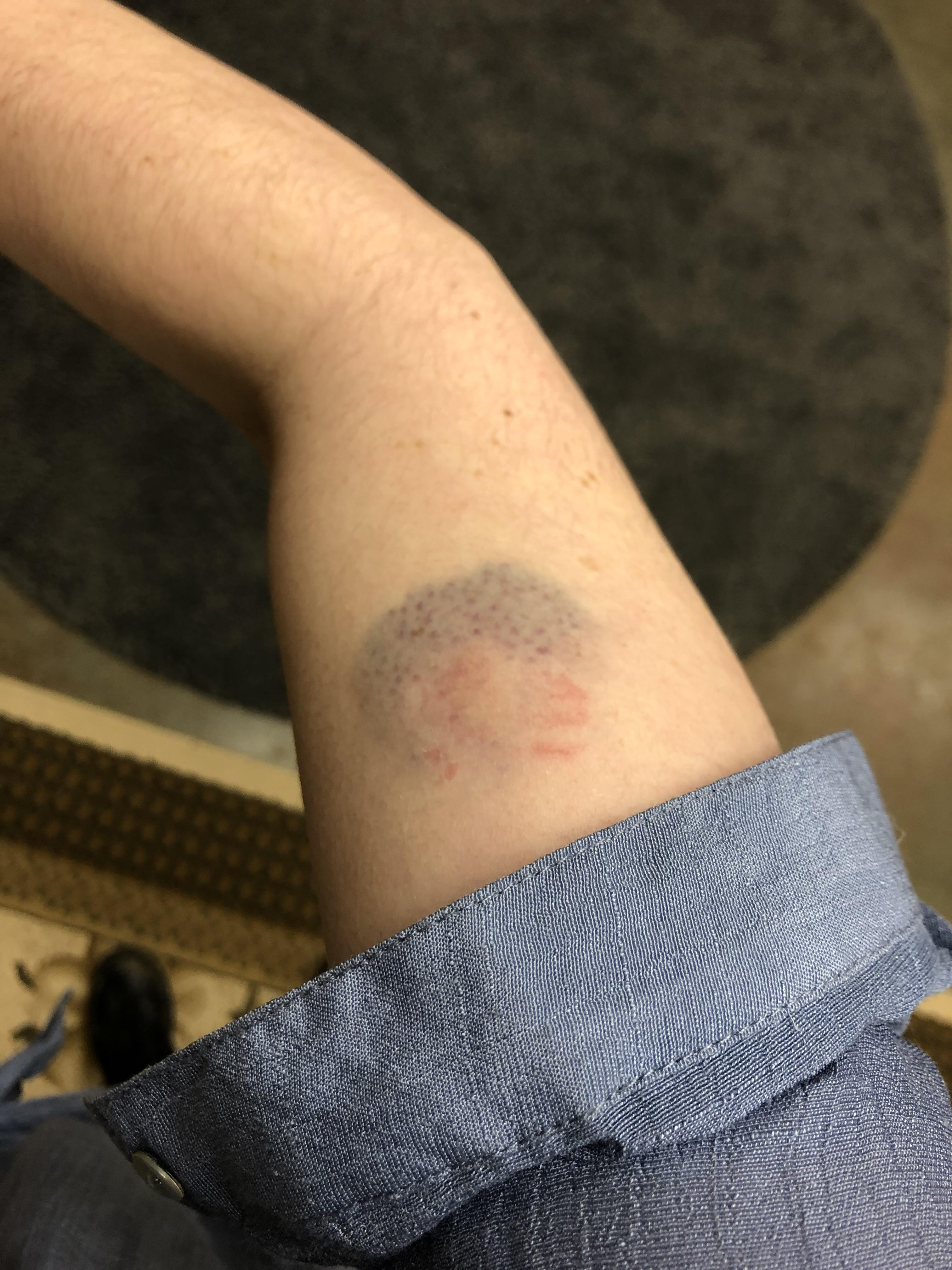Bite mark from a 4 y/o. Wondering if medical attention is needed? r