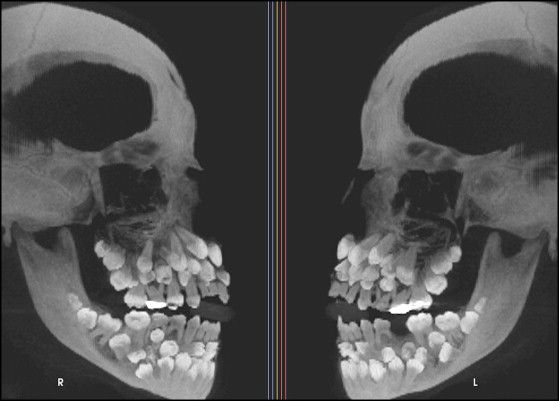 Toddler Skull XRay (probably a repost) pics