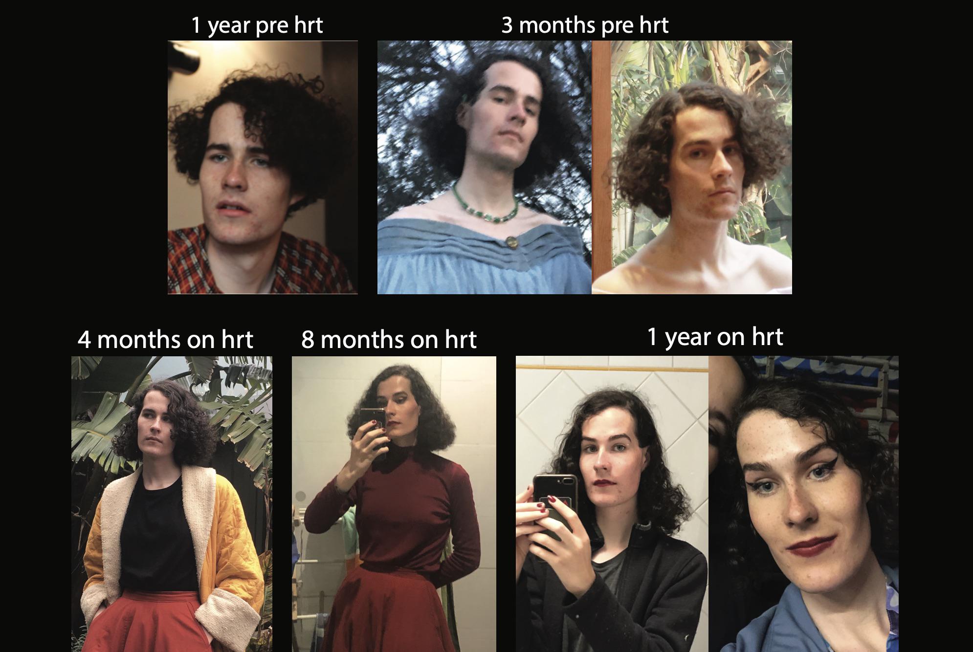 One year on estrogen and 10kg weight gain r/transtimelines