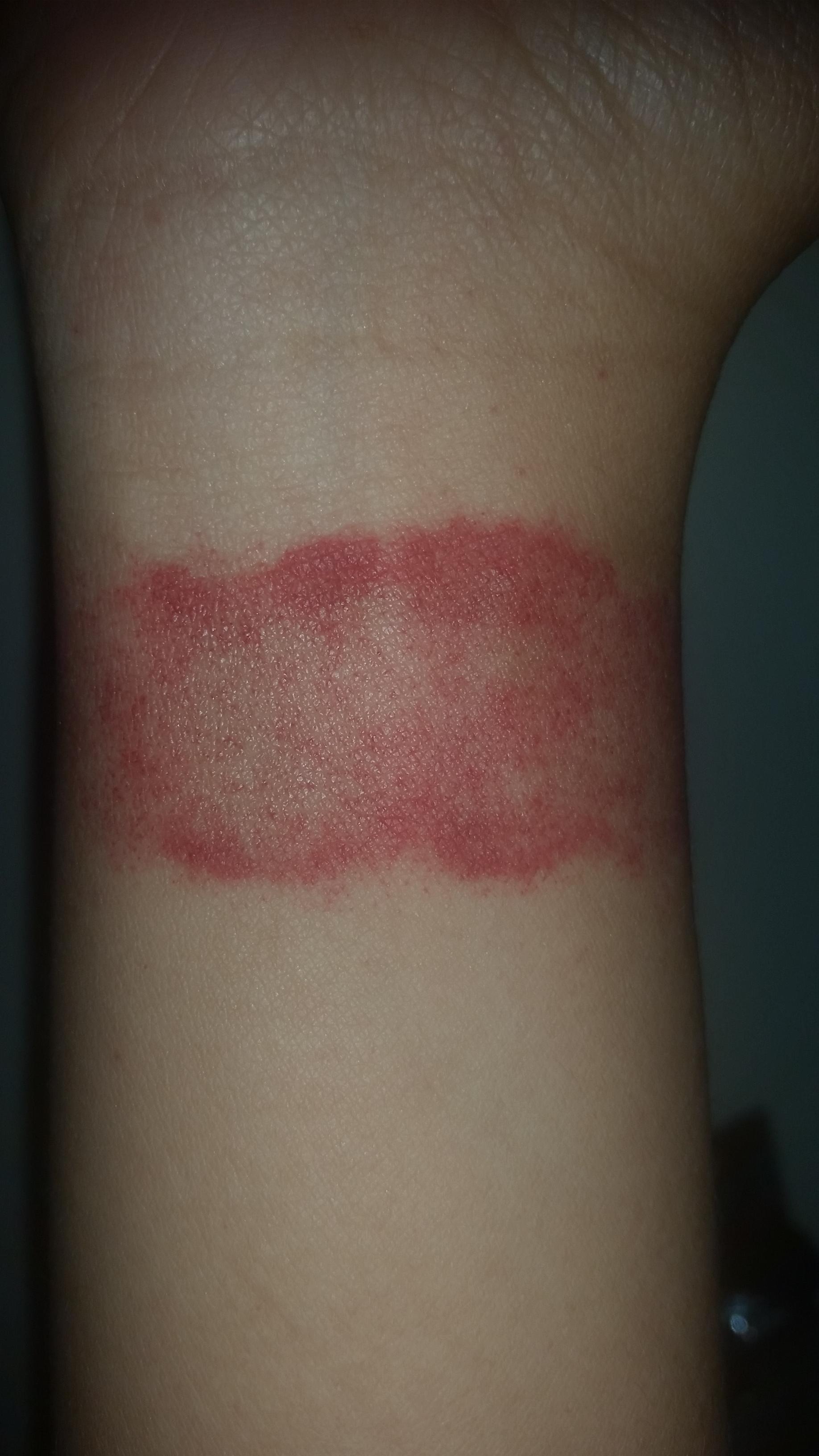 Skin Rash On Wrist