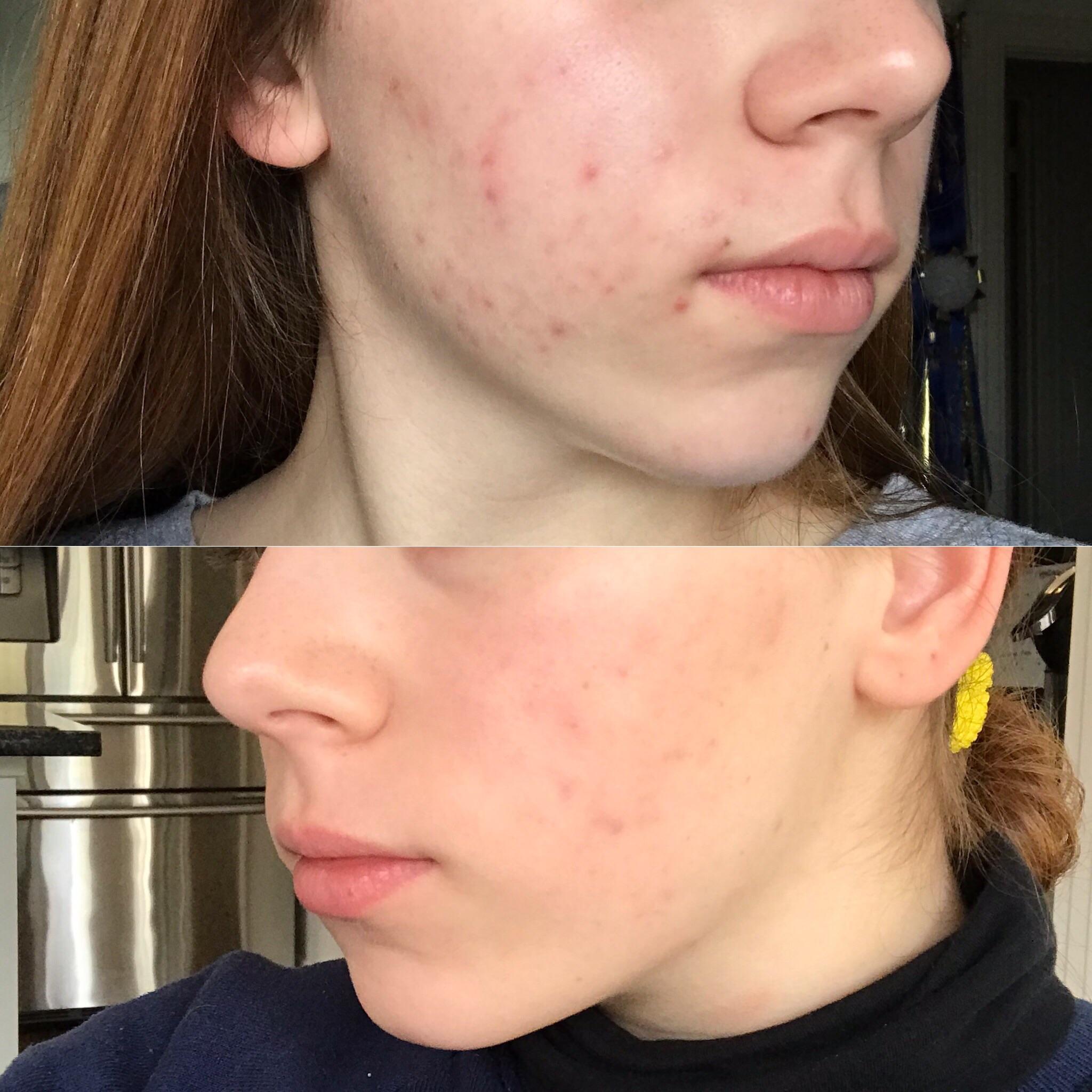 2.5 months in! (Started with moderate but stubborn cystic acne) 3/5