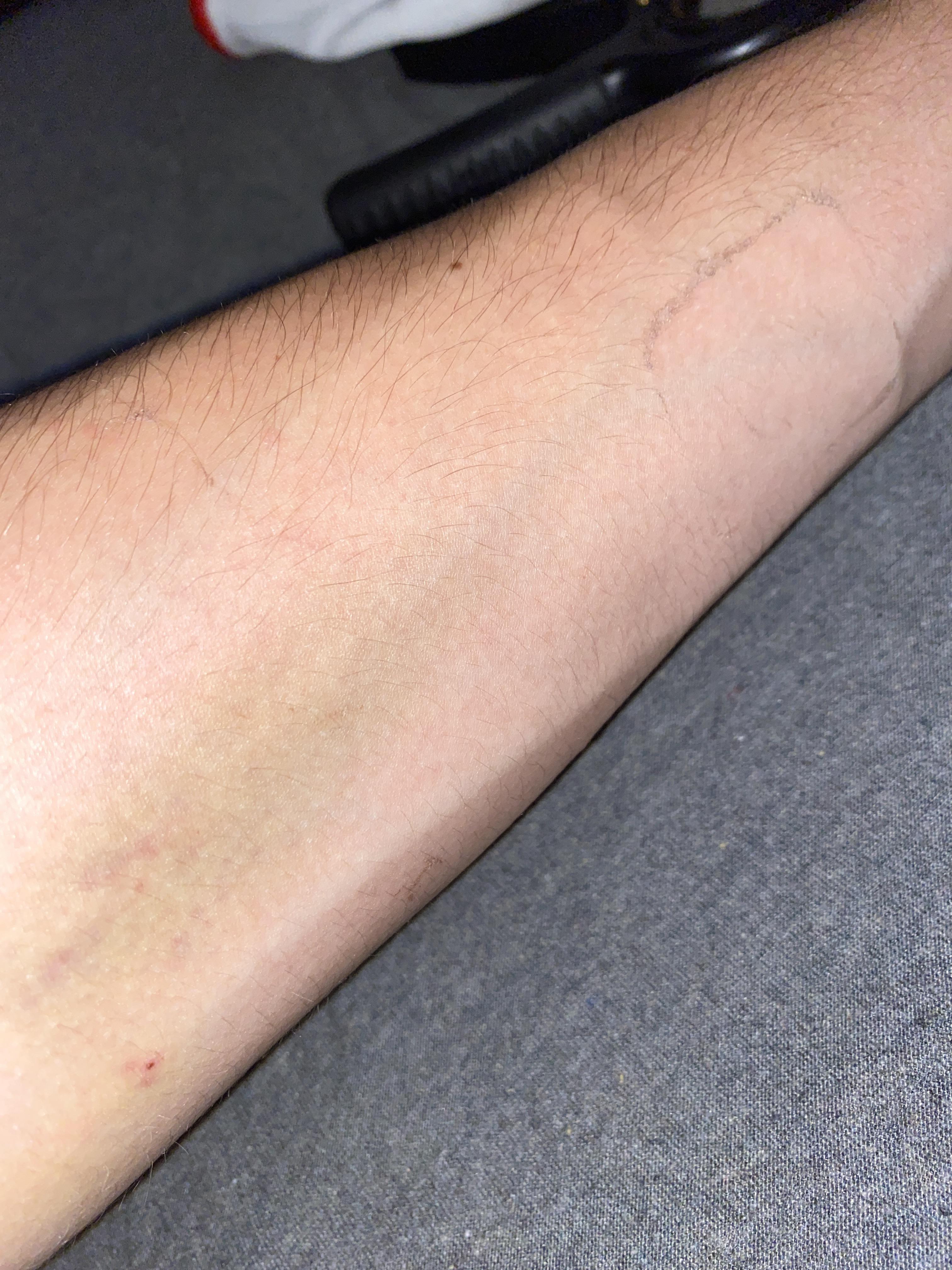 Green bruise going down my arm for the past few days after IV being