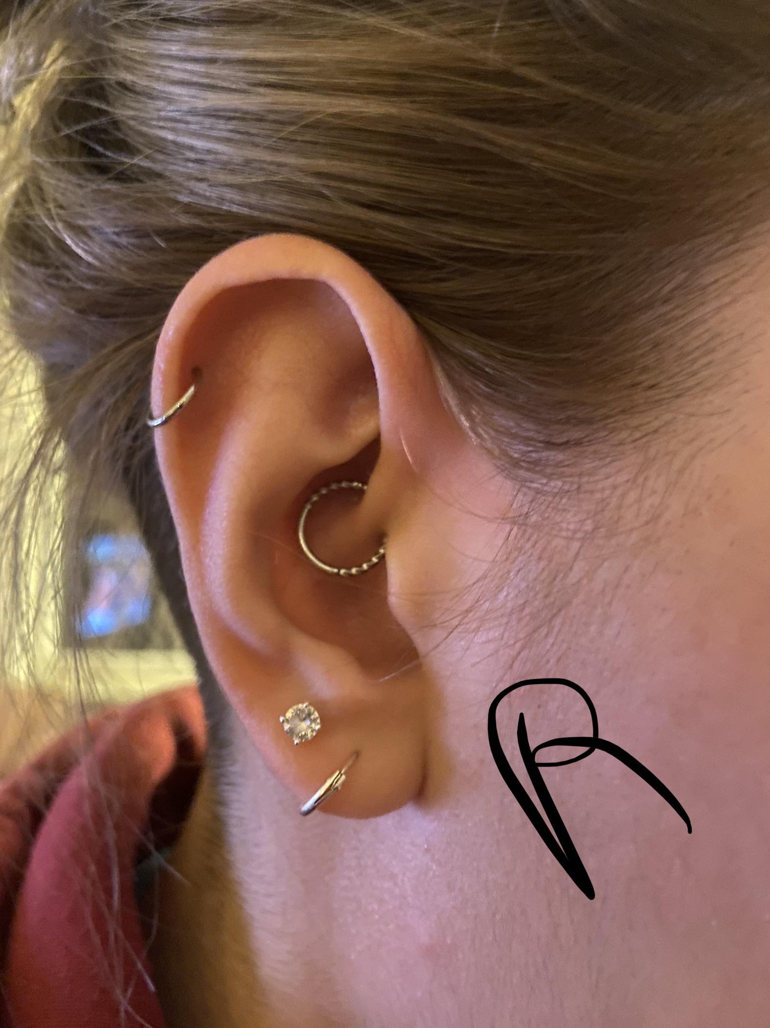 Keloids with nipple piercings? PiercingAdvice