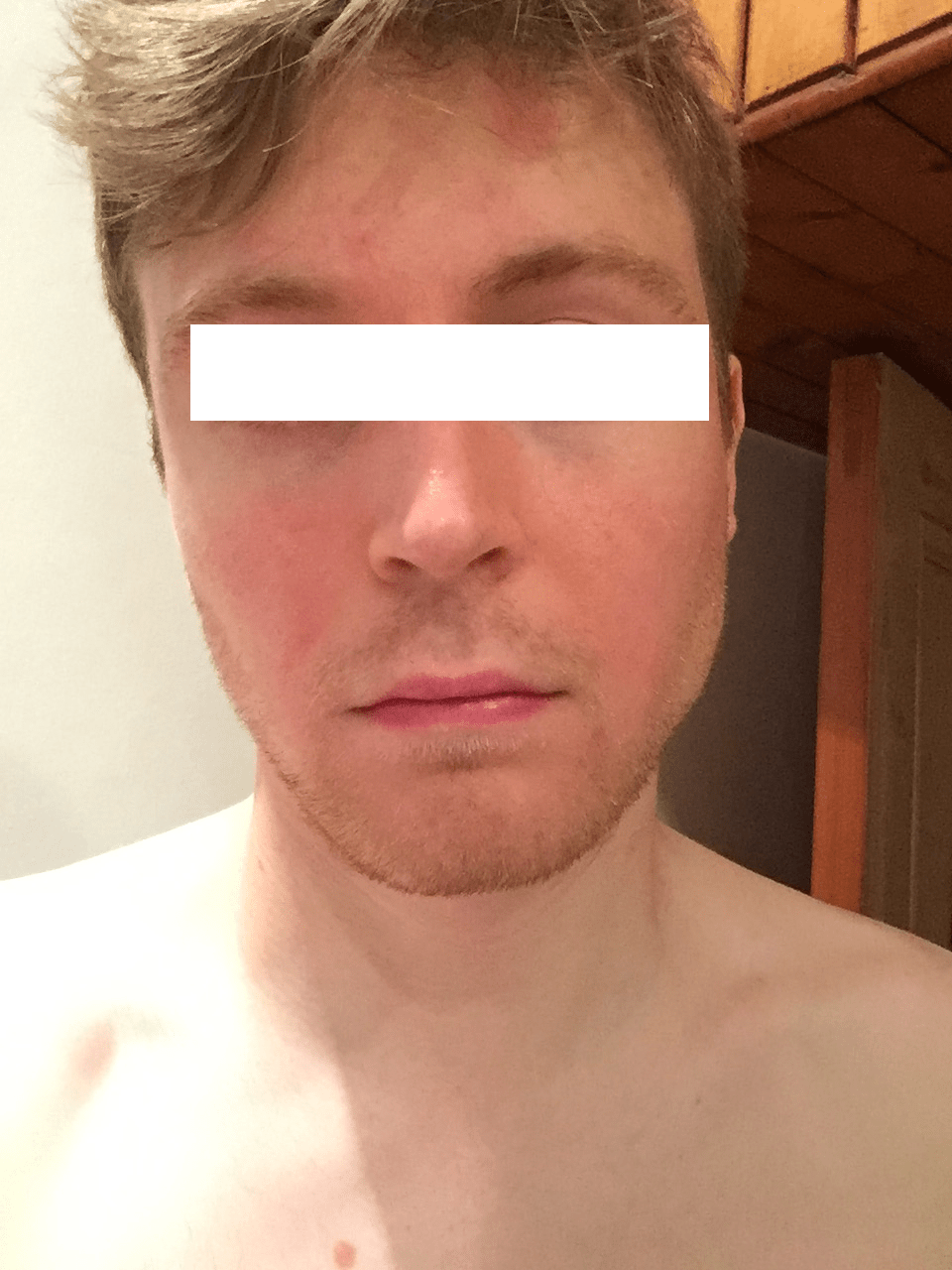 Accutane induced rosacea r/Rosacea