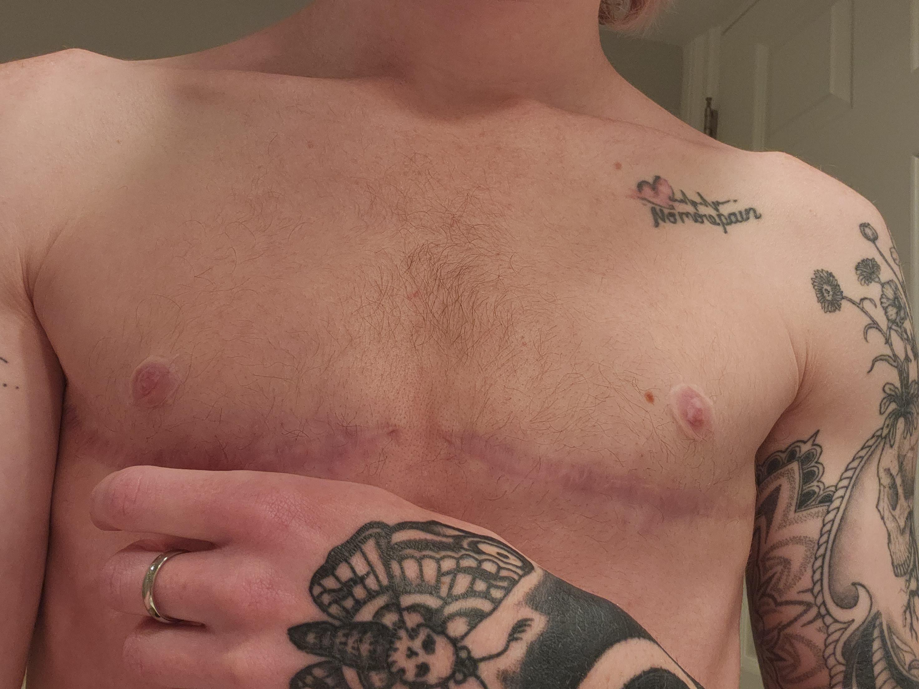 9 months post op and I have never been happier. I recently started