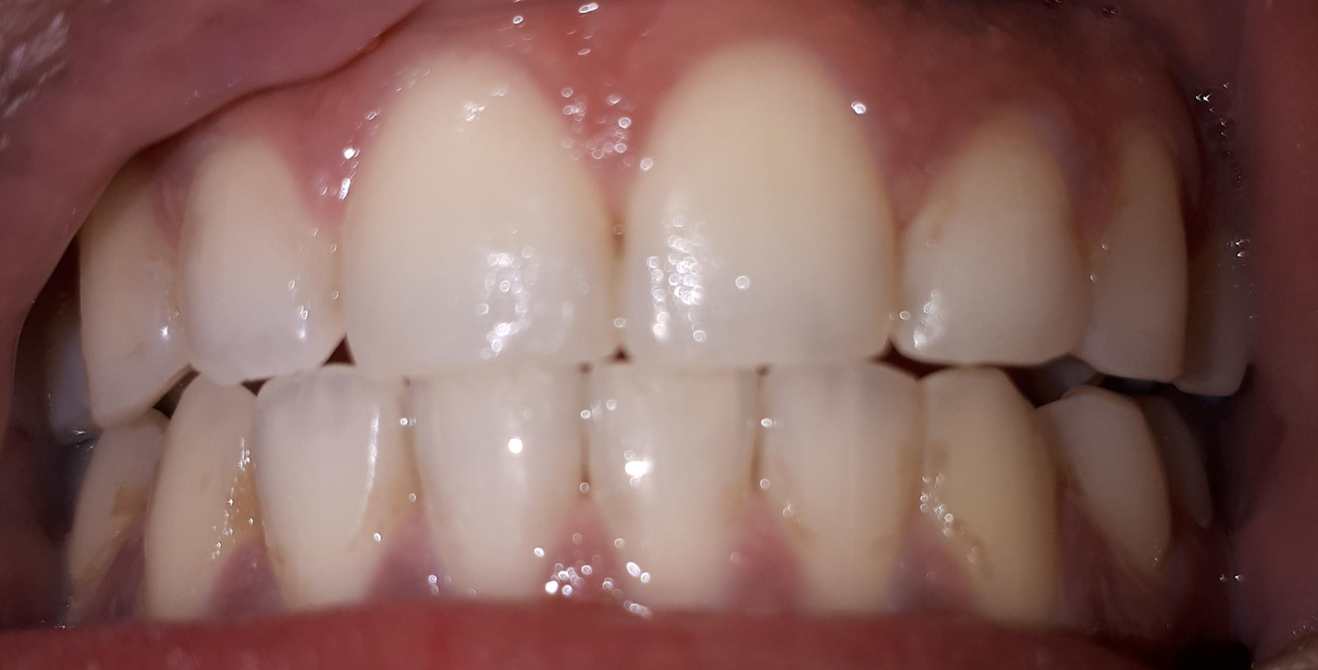 Does my teeth and bite look normal?just had braces removed and mt lower