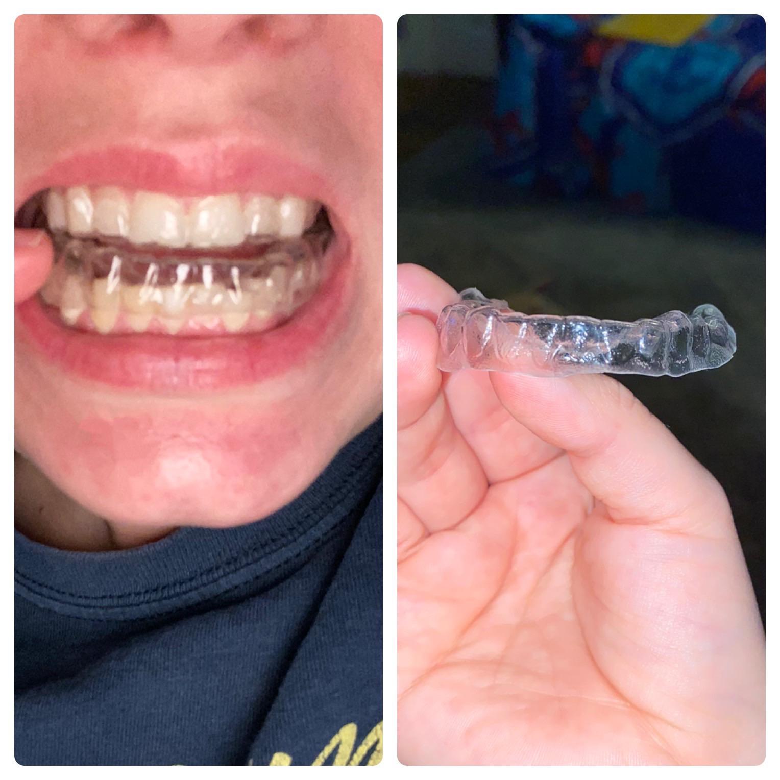 These Aligners aren’t fitting anymore... I’m on my last 3 and it keeps