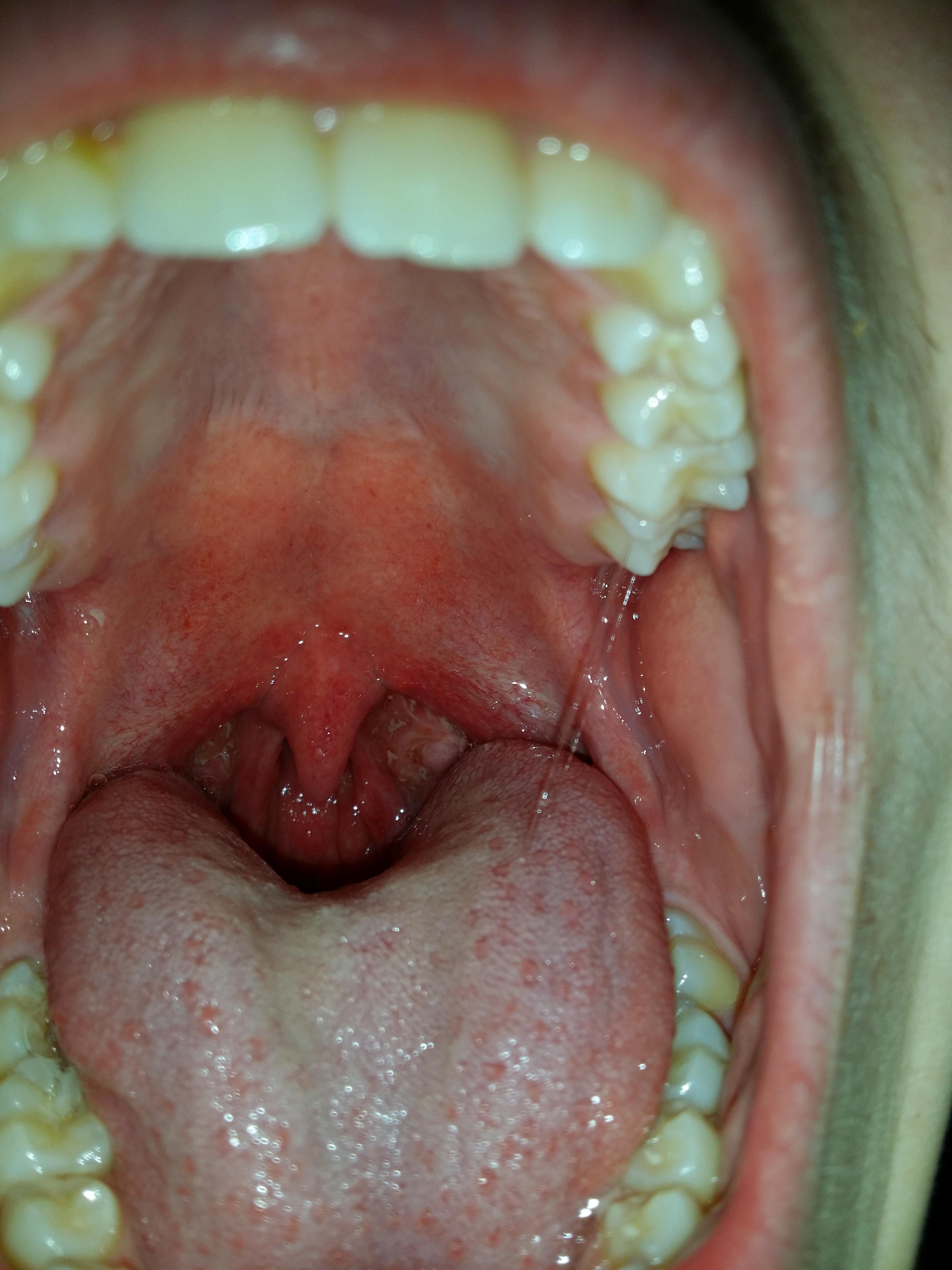 White spots in the back of my mouth (tonsils?), it hurts when I swallow