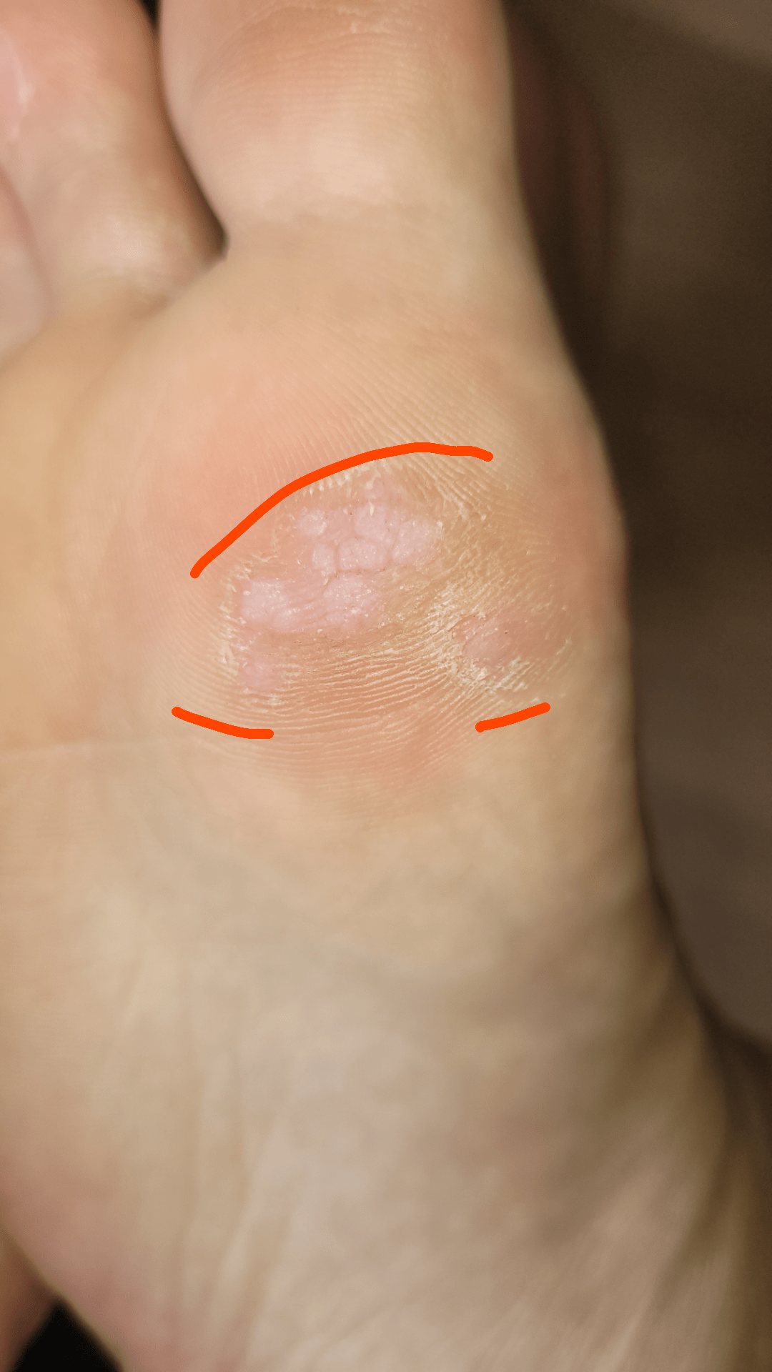 Plantar wart treatment r/DermatologyQuestions
