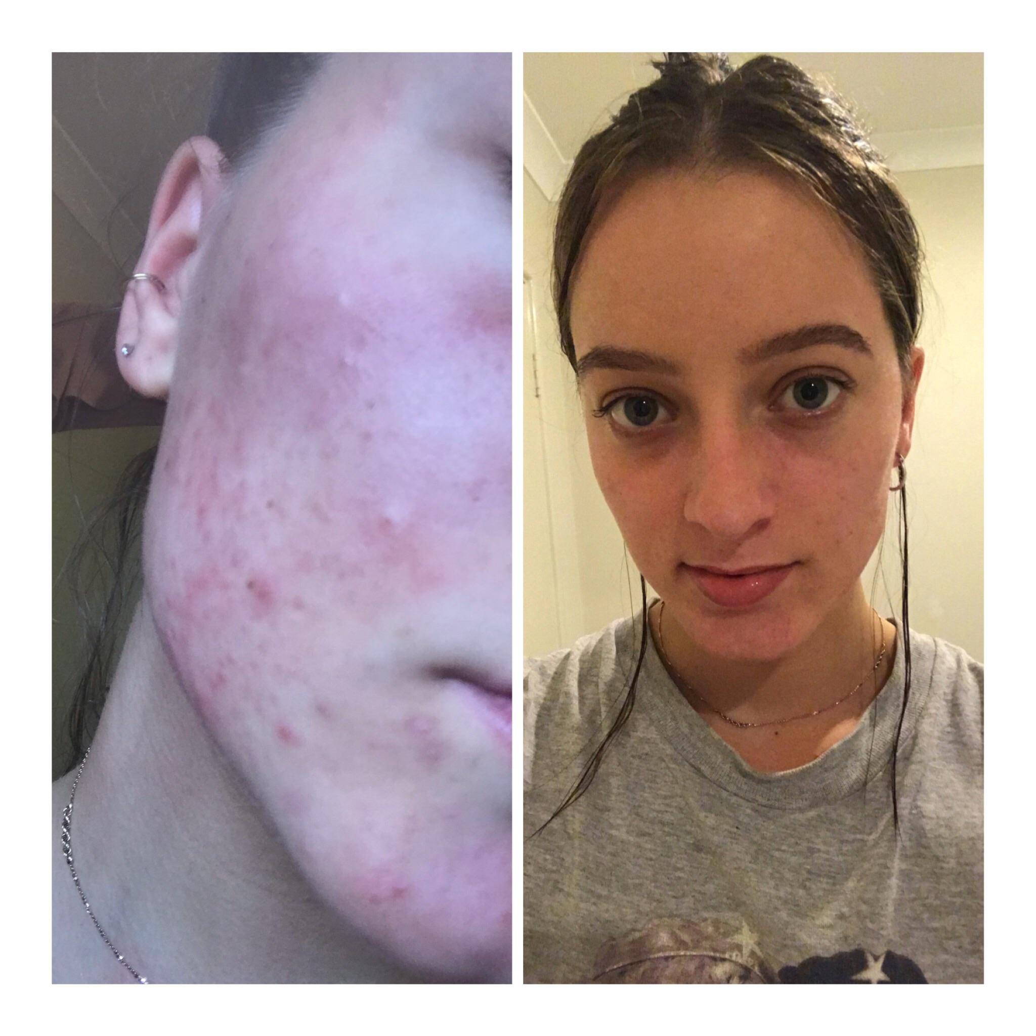 3 weeks on Epiduo gel. 90 clear and scars have nearly completely faded