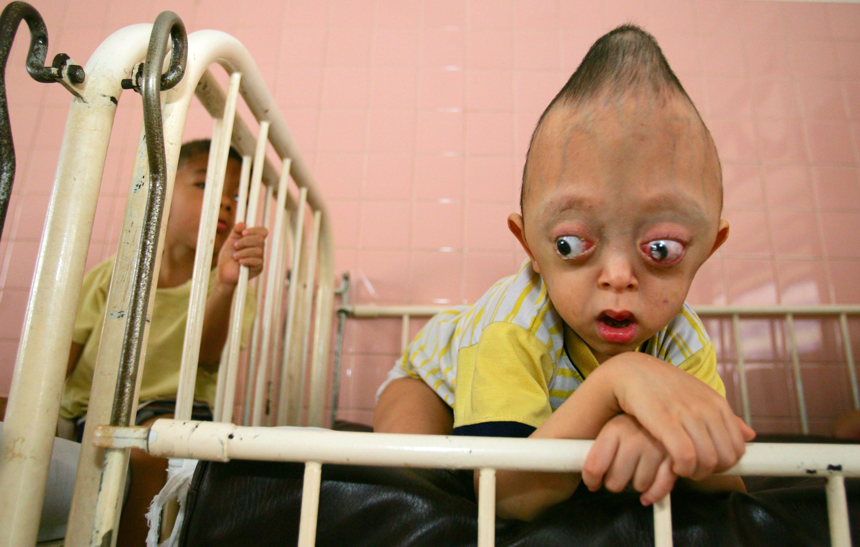 This is a child in Vietnam born with a birth defect due to his parent's