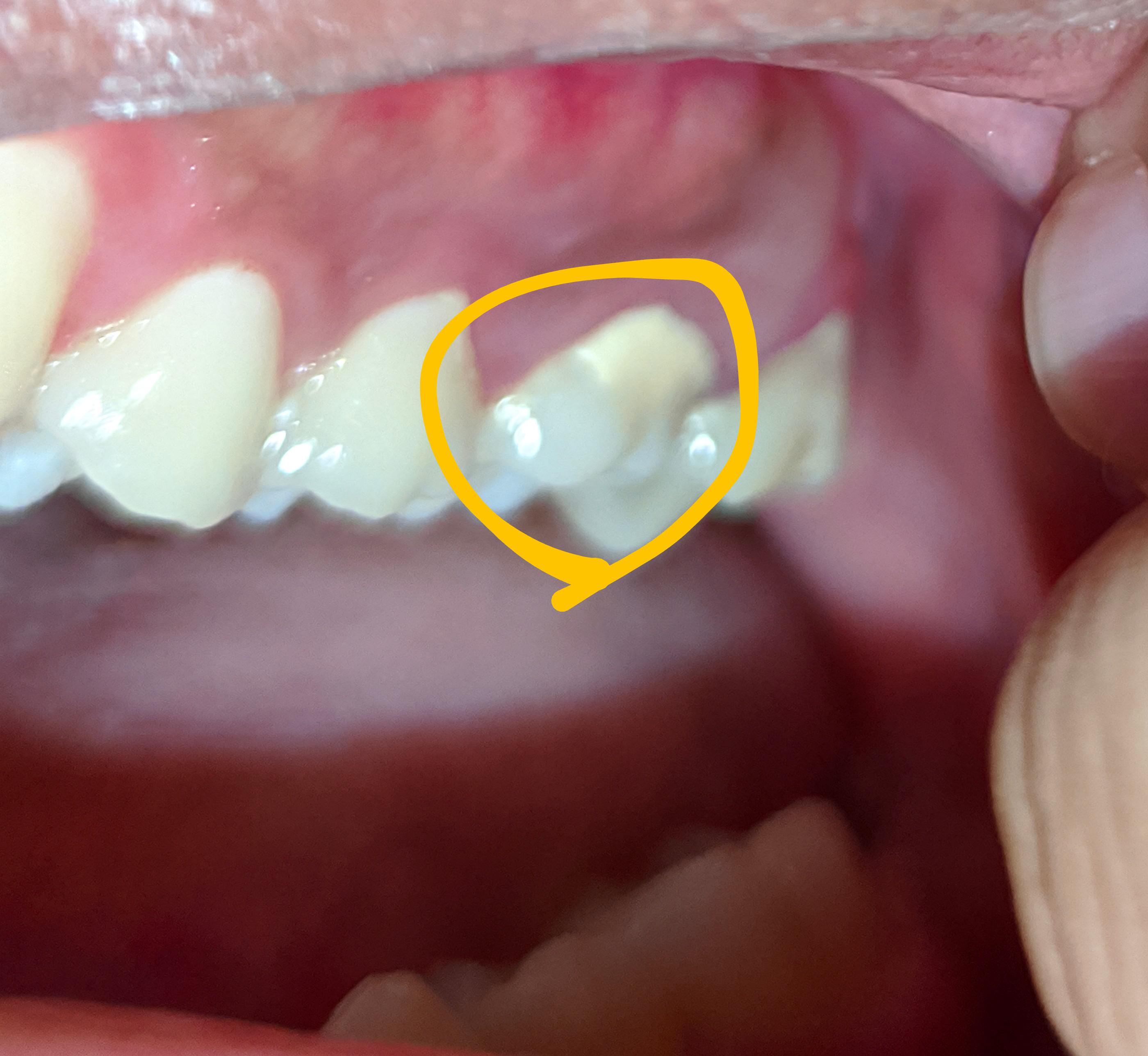 why is my tooth like that? it feels a bit rough. I start noticed it