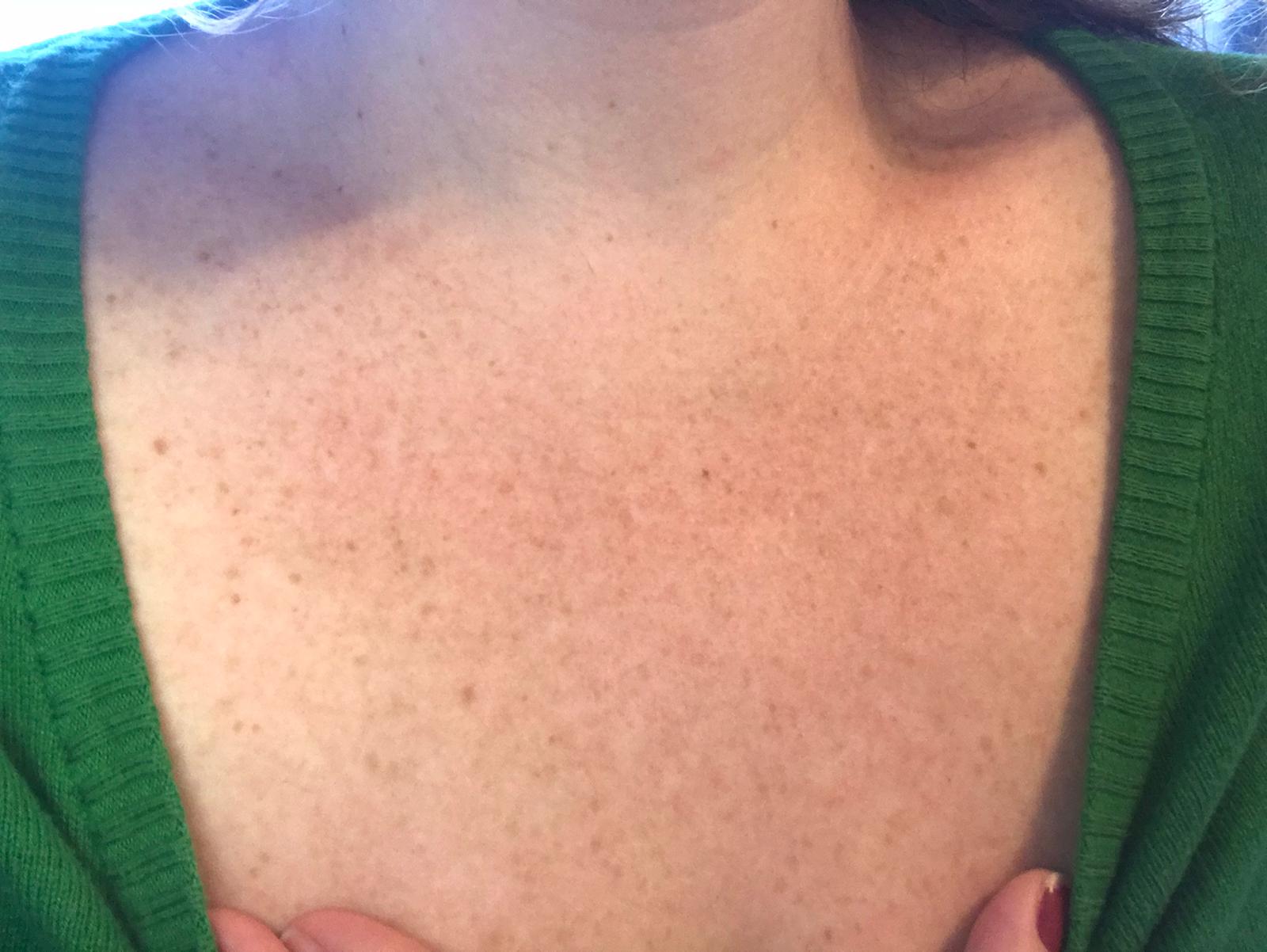 [Skin Concerns] [Anti Aging] Advice for sun damage on chest? Just