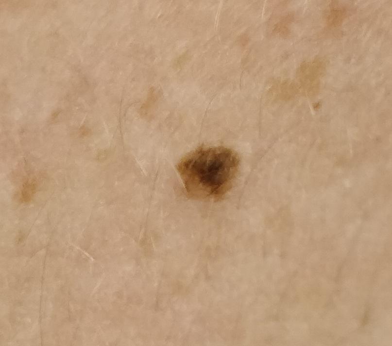 Does this mole look concerning? I just noticed it on my upper arm and it's very dark compared to