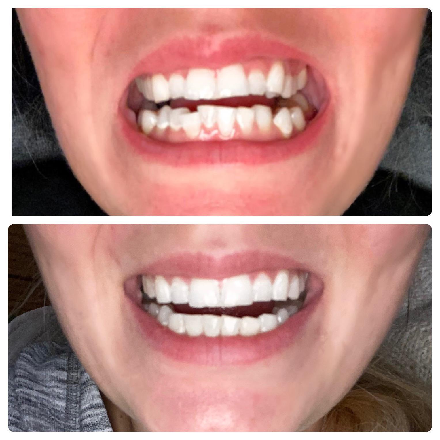 HIGHLY recommend smile direct : r/smiledirectclub