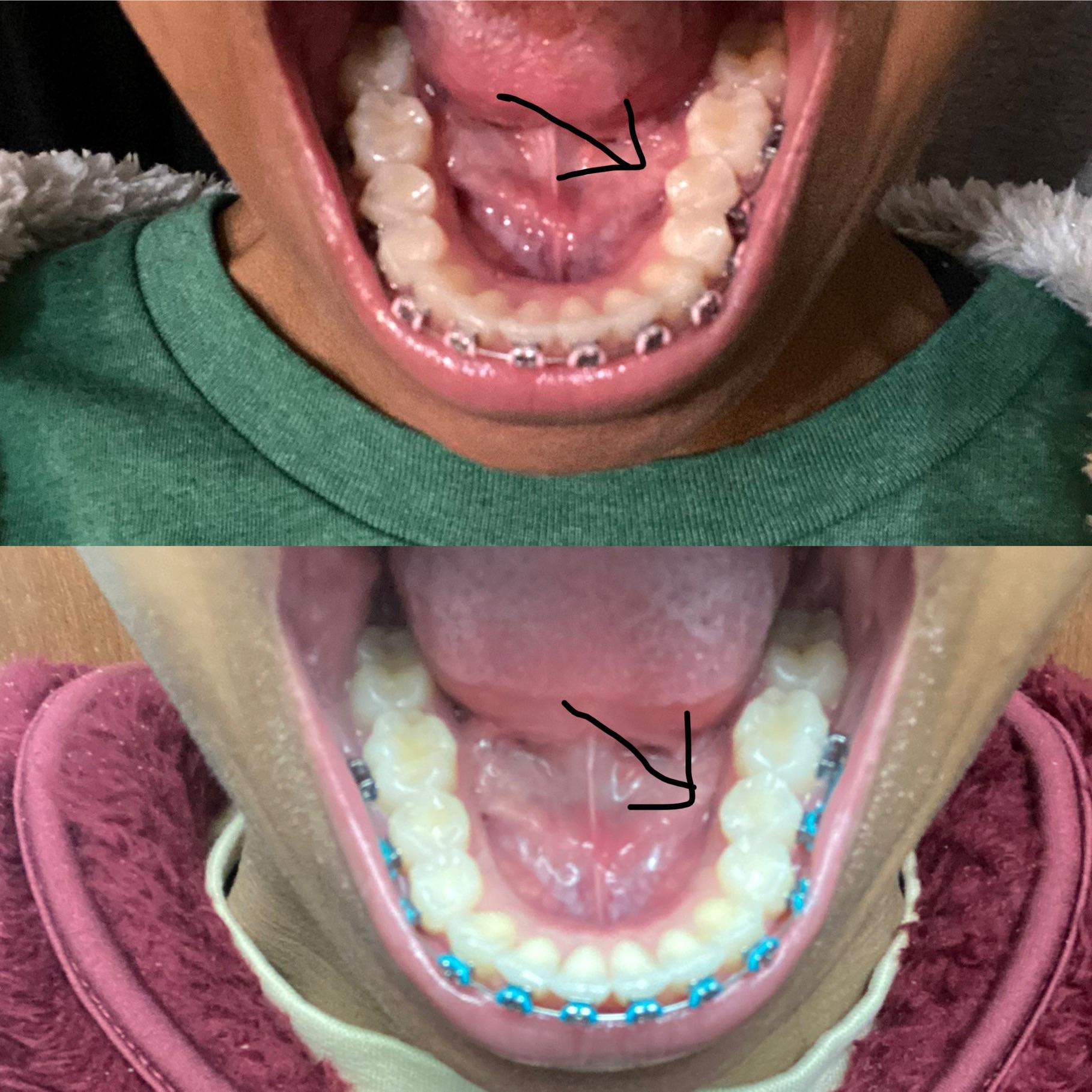 Small progress but look at how my tooth has rotated! 2nd adjustment in