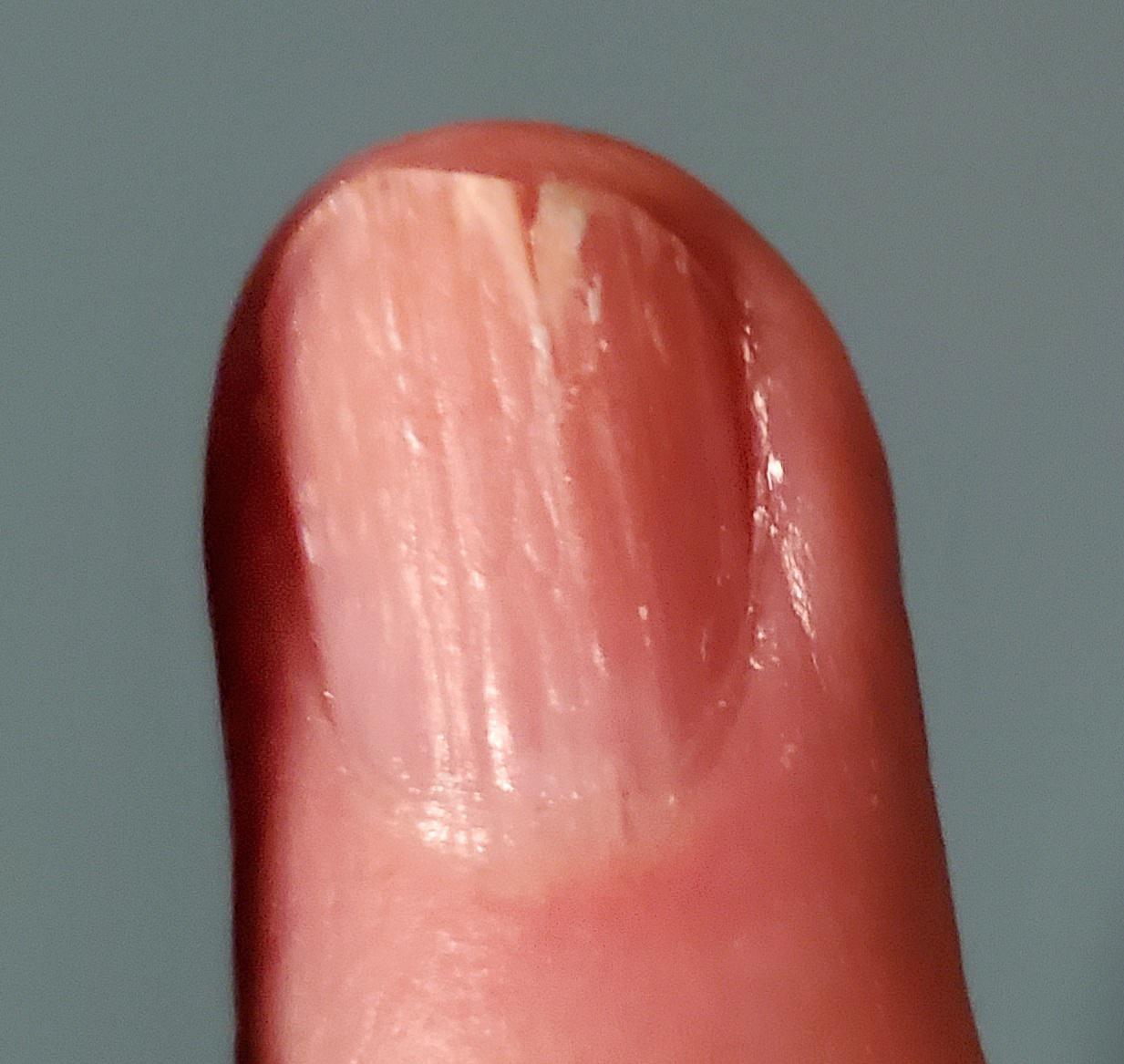 My fingernail will only grow like this. r/mildlyinteresting