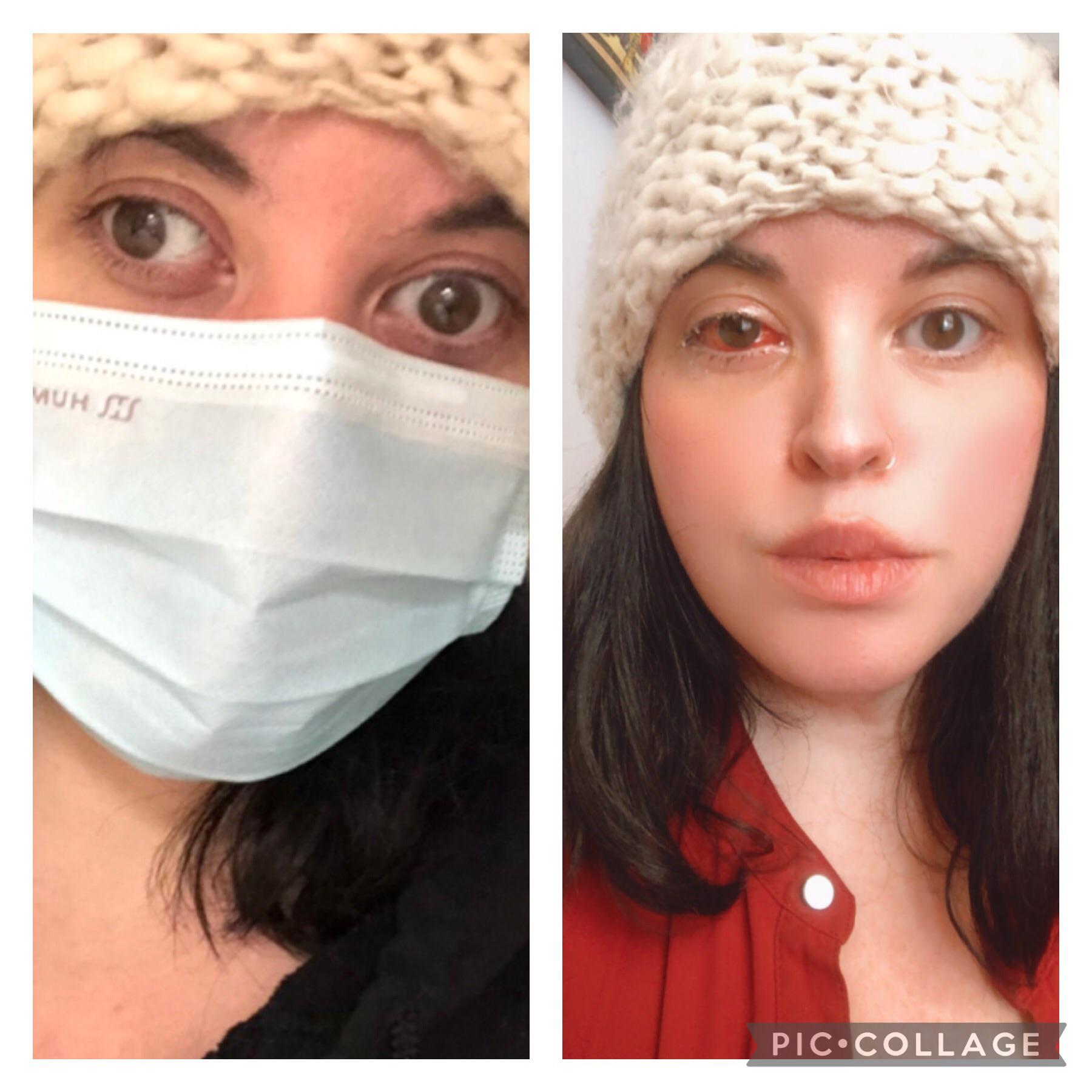 Update on eye since surgery on the 28th. Still very red