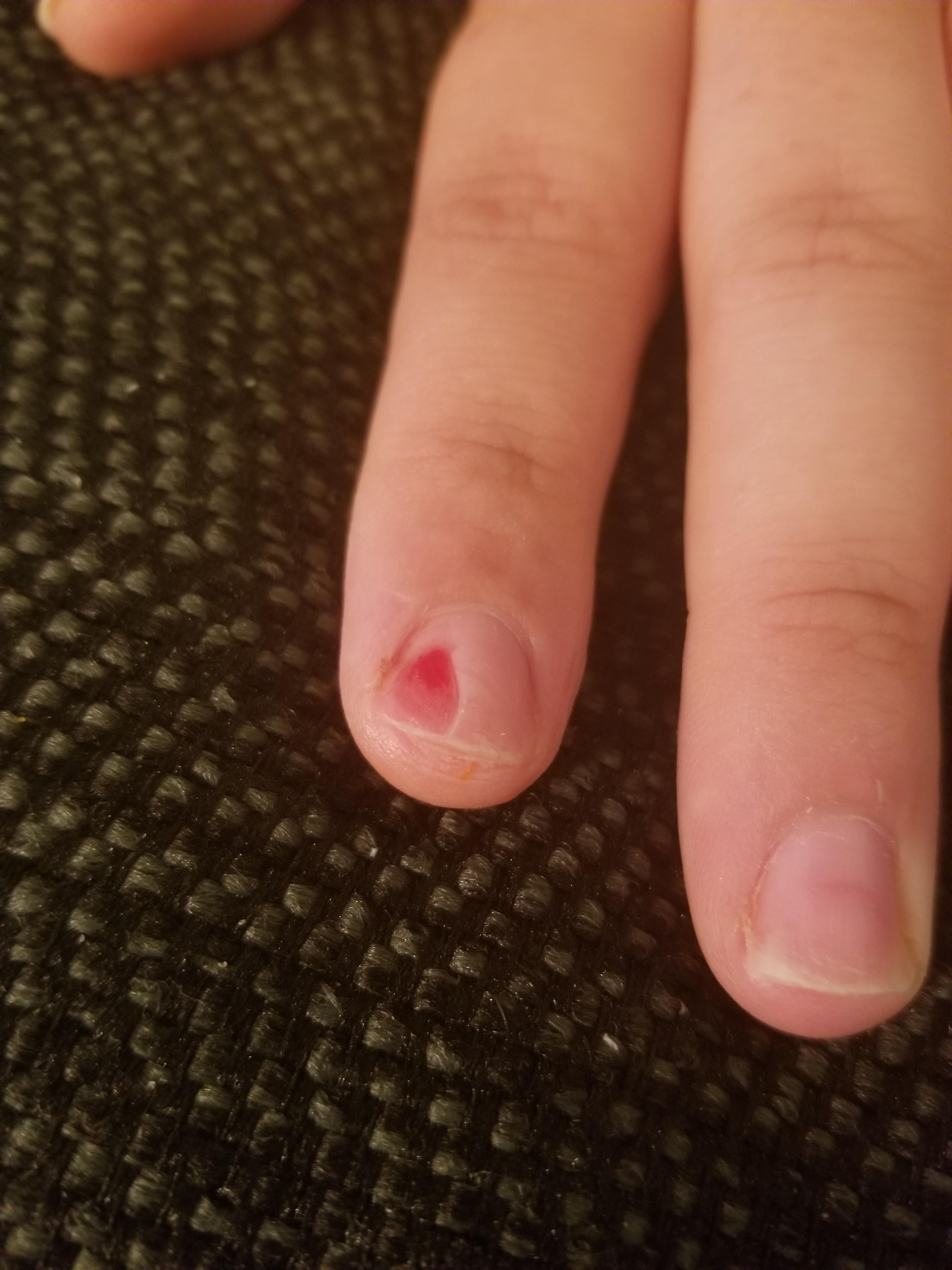 My wife (F29) sliced off part of her finger nail while chopping vegetables and we were just