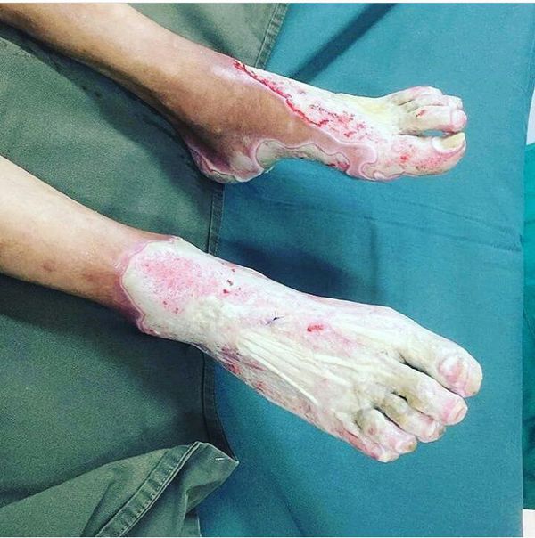 Third (3rd) degree burn on both feet after dipping them in boiling