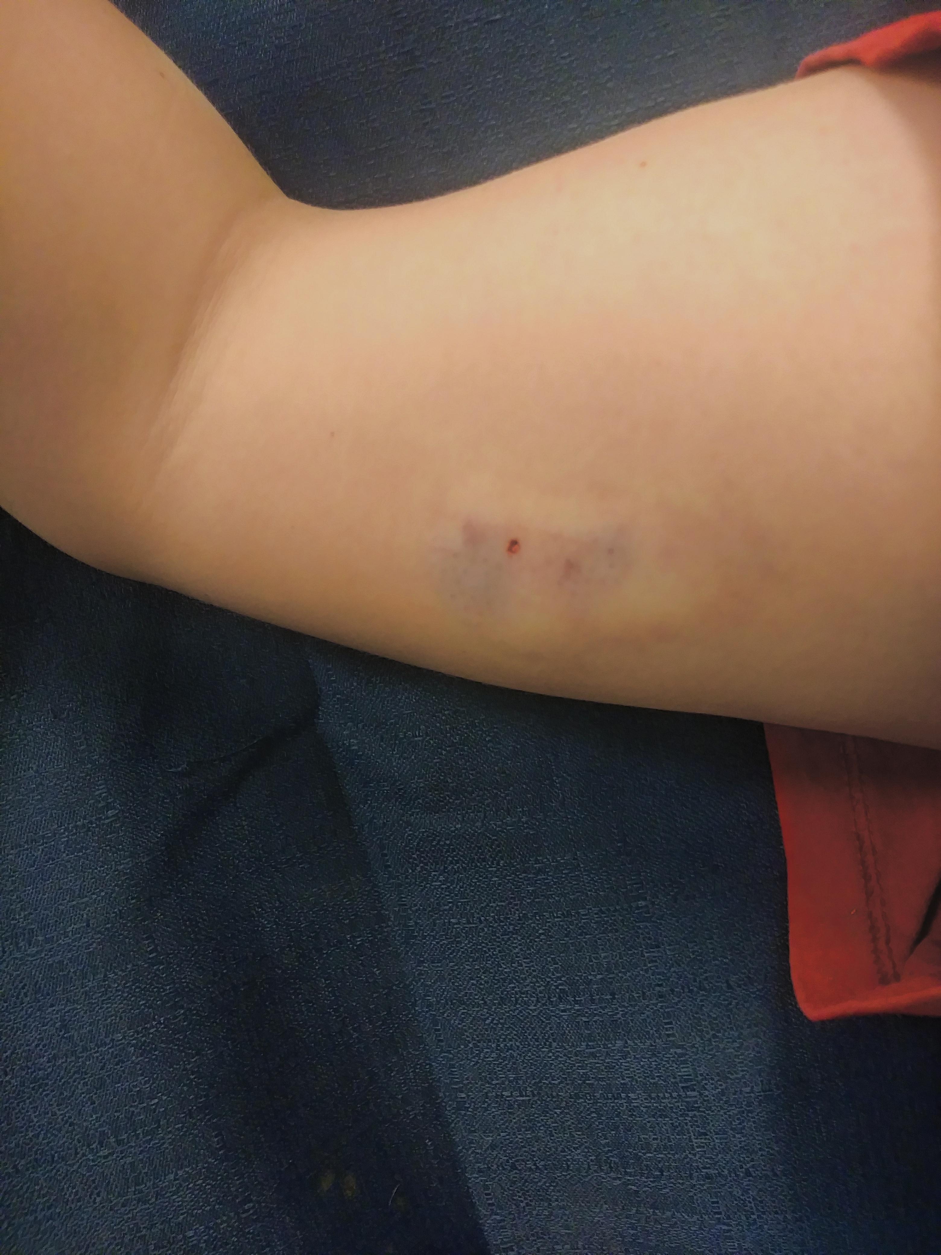 just got nexplanon birthcontrol