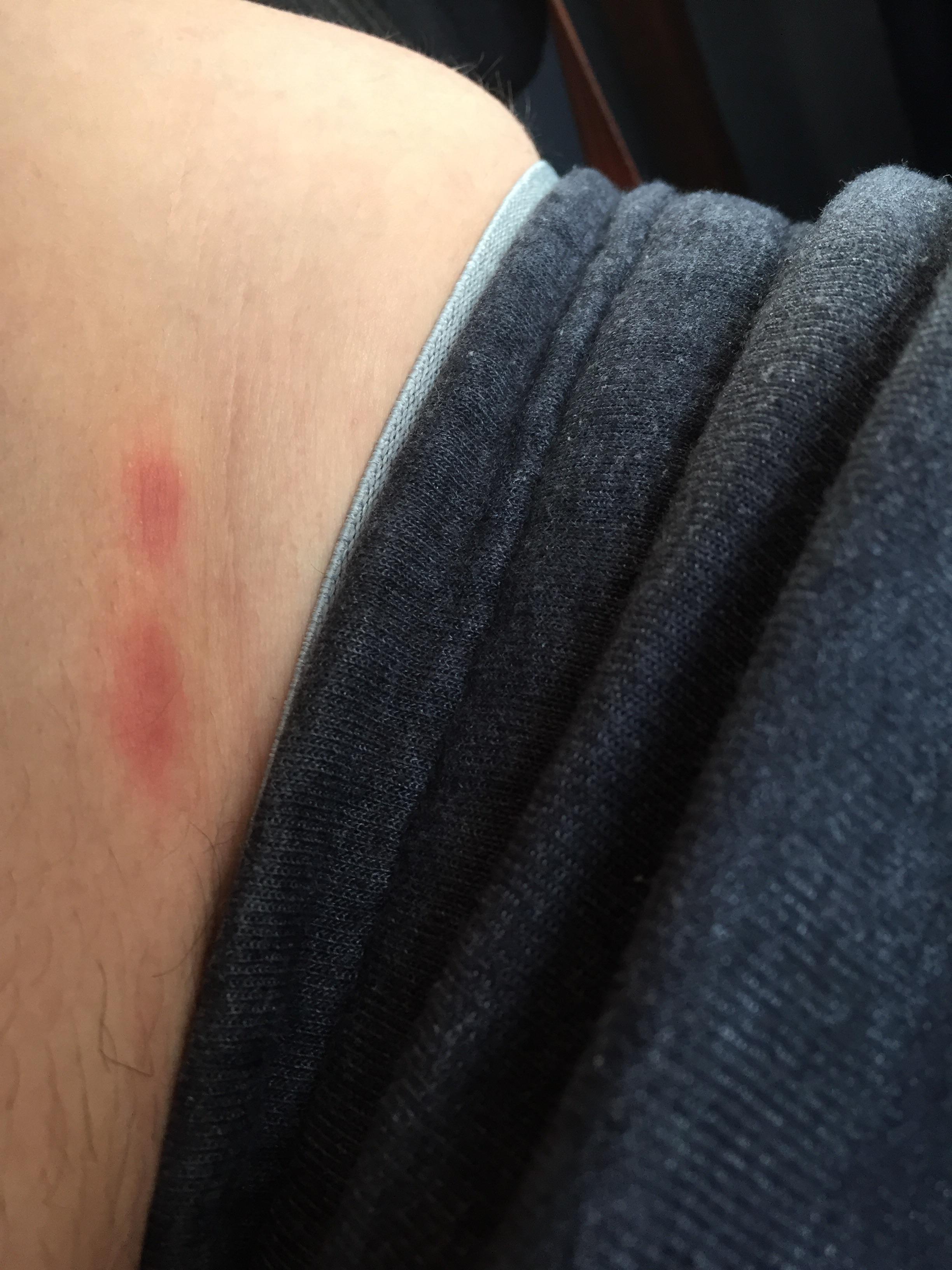 Do these look like bed bug bites??? I have two more below my waist band