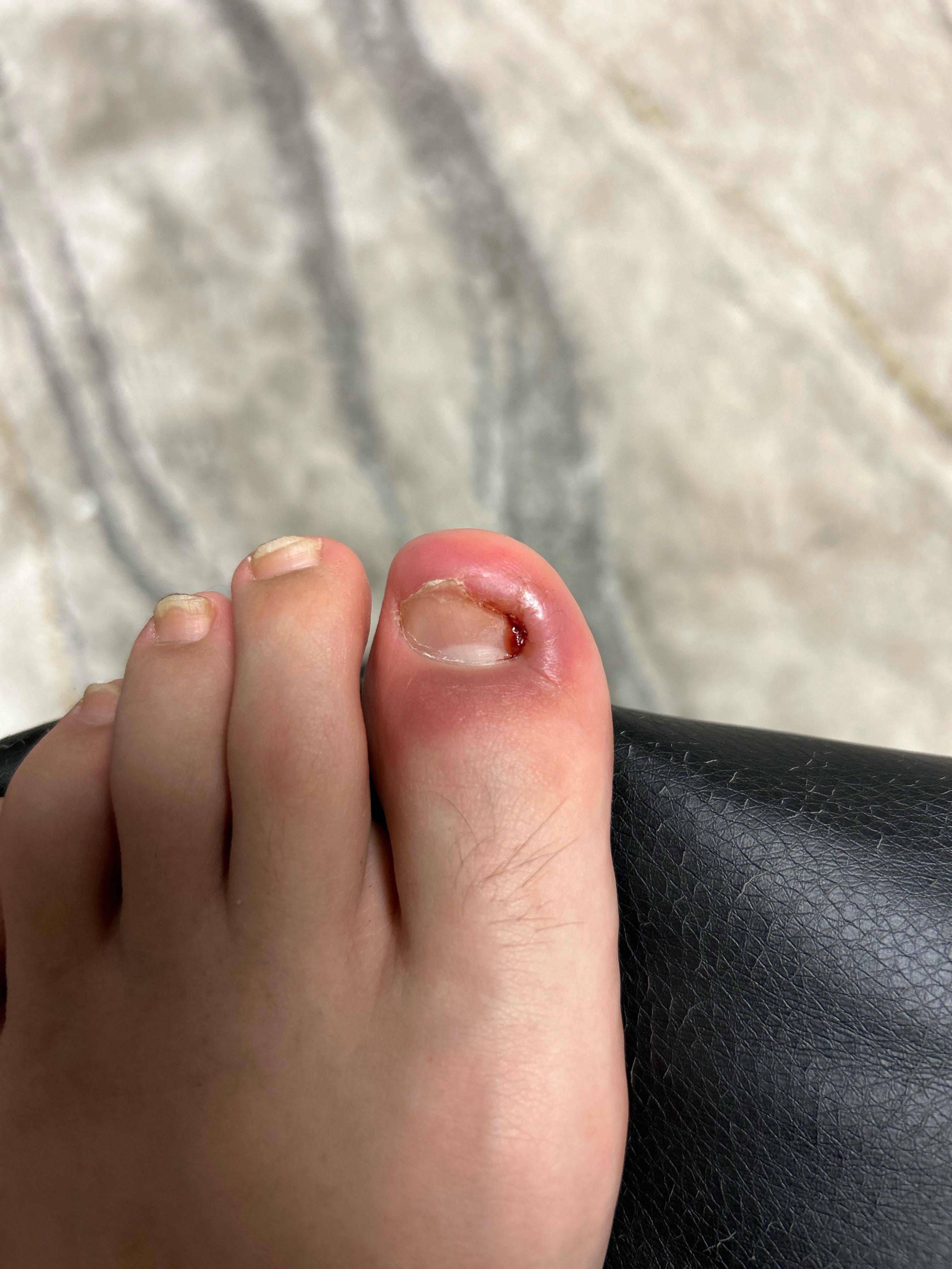 Is my toe infected or just swollen r/Ingrown_Toenails