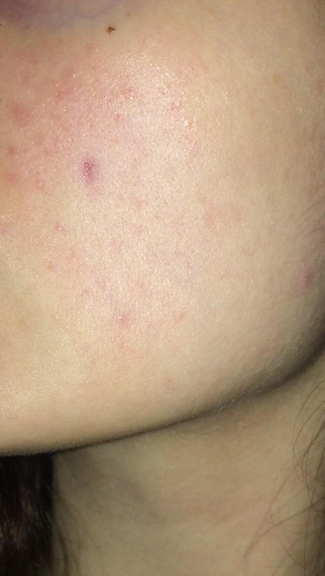 [Skin Concerns] Will nightly 10 glycolic acid reduce this PIH over