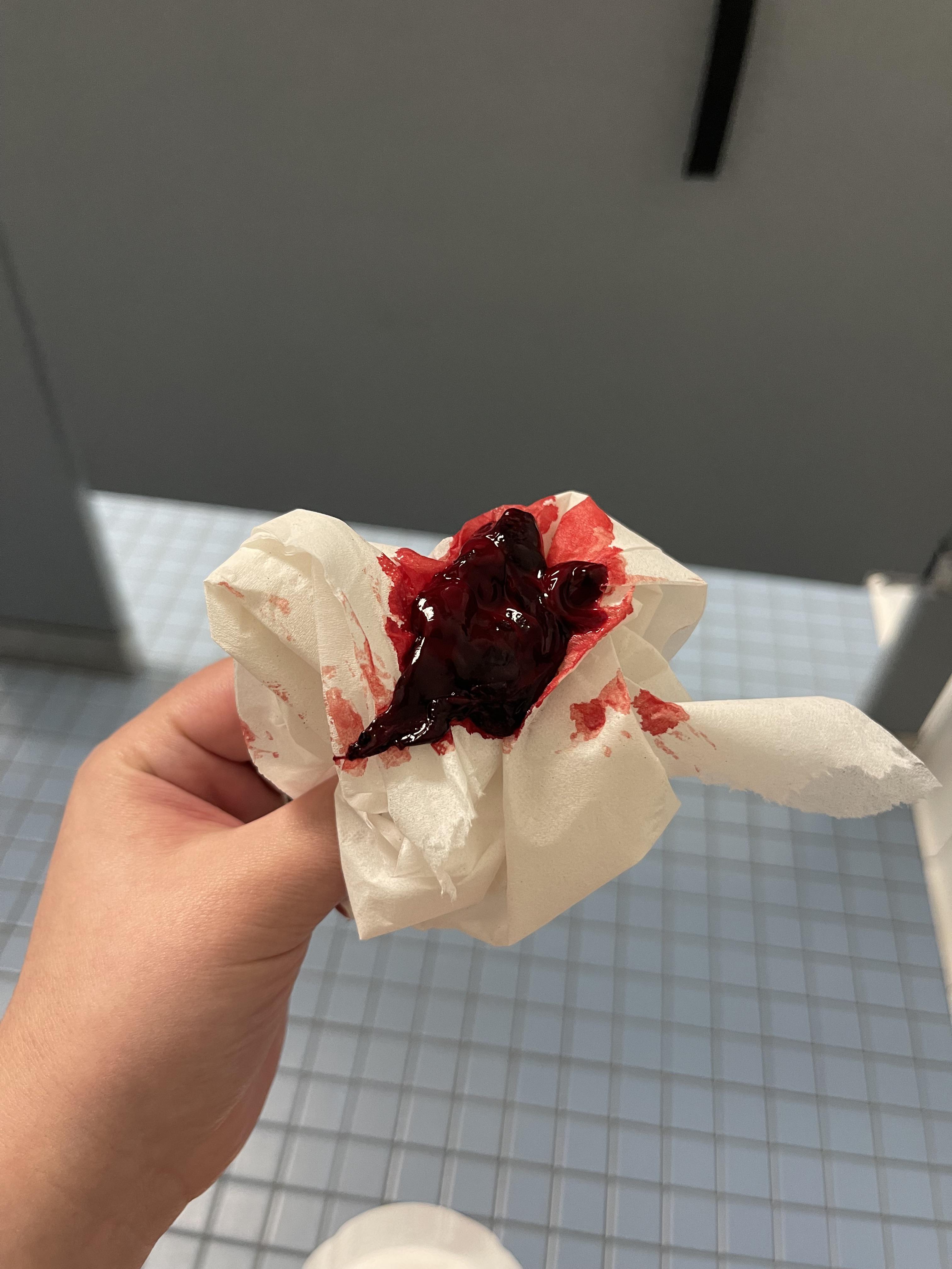 Endo clot? 🩸 r/endometriosis