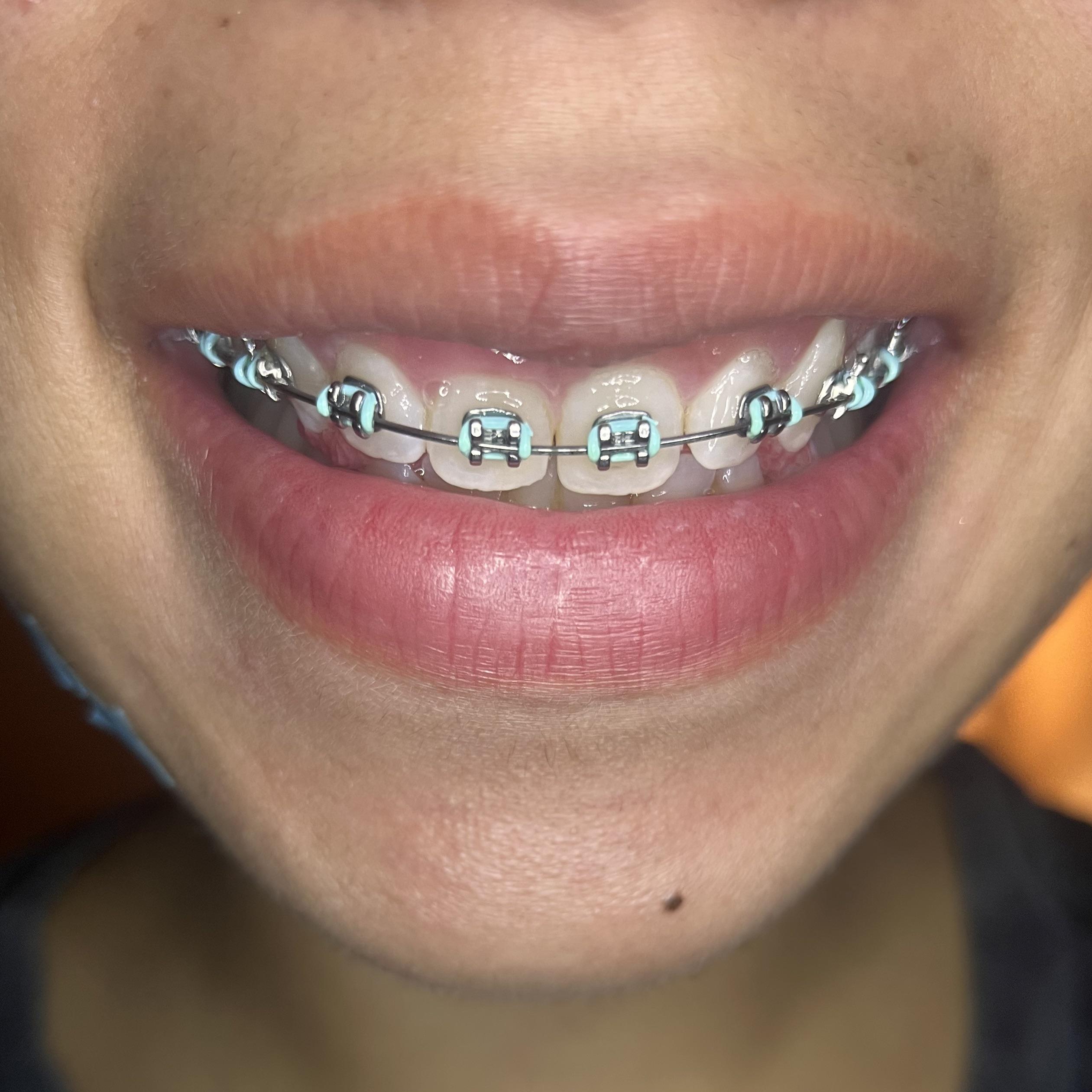 Day 1!! 23 F. Day one of my braces journey. I constantly have been